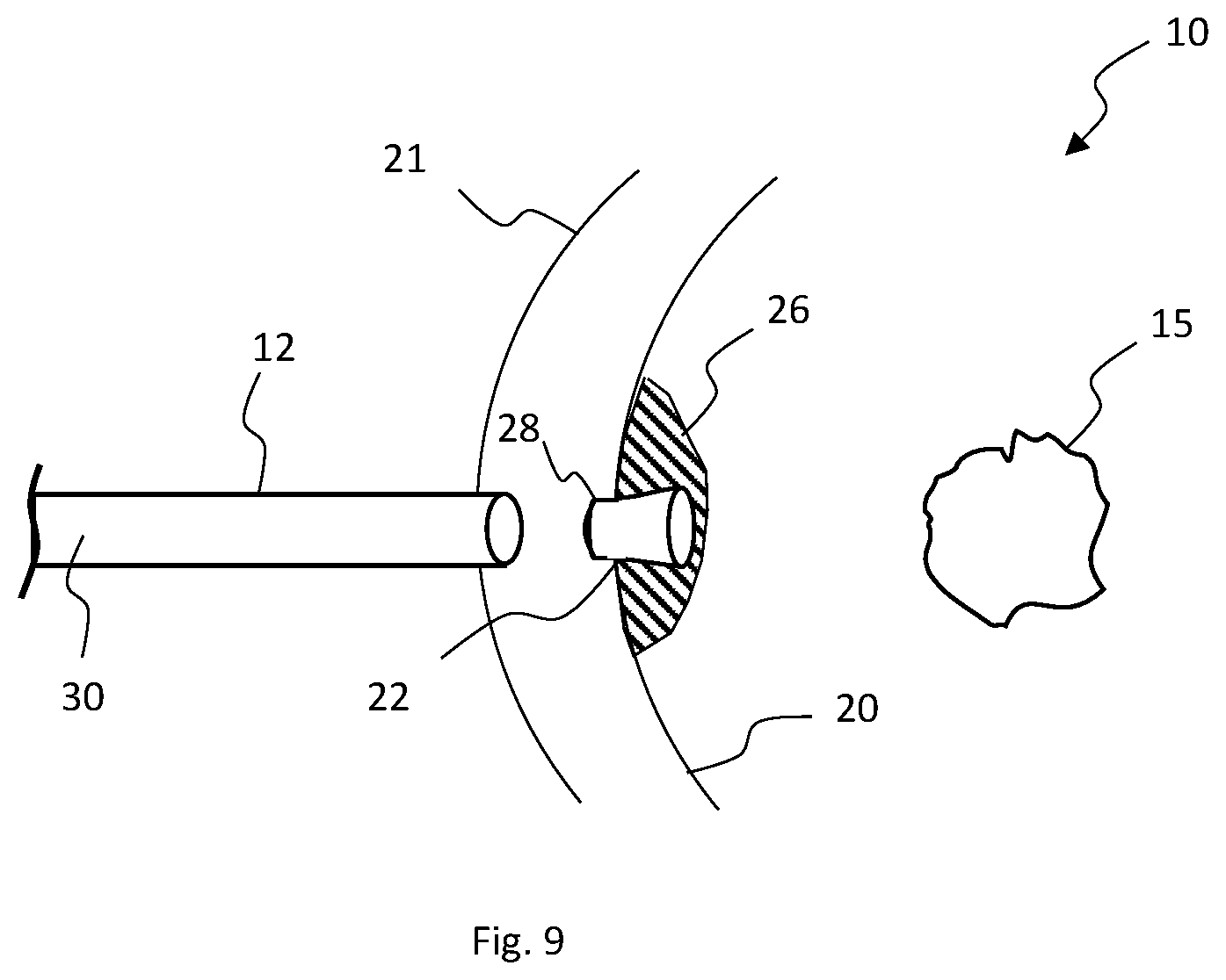 Patent US12324587 Figure 5 – Multistage bioabsorbable plug system