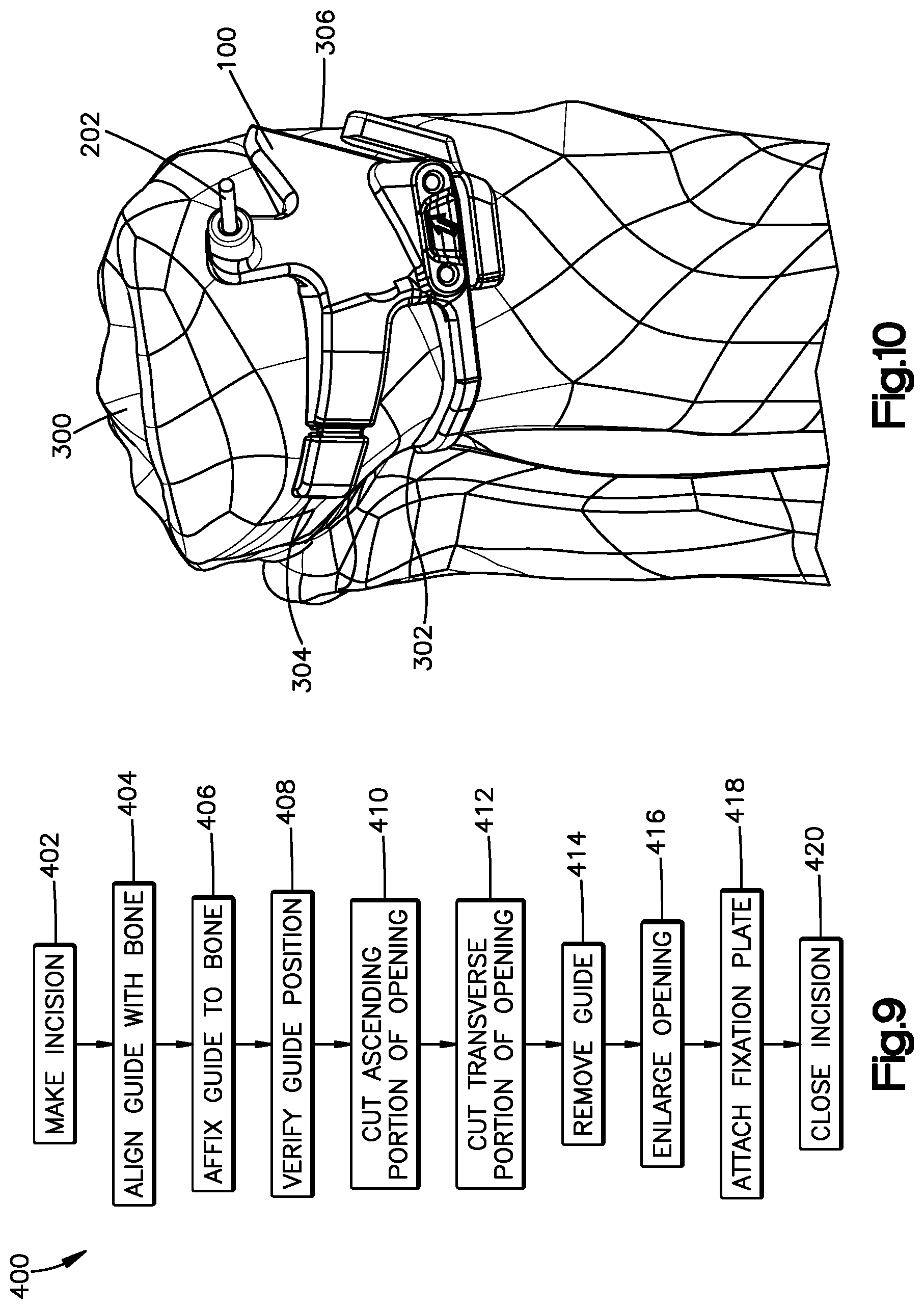 Patent US12324591 Figure 5 – Osteotomy guide