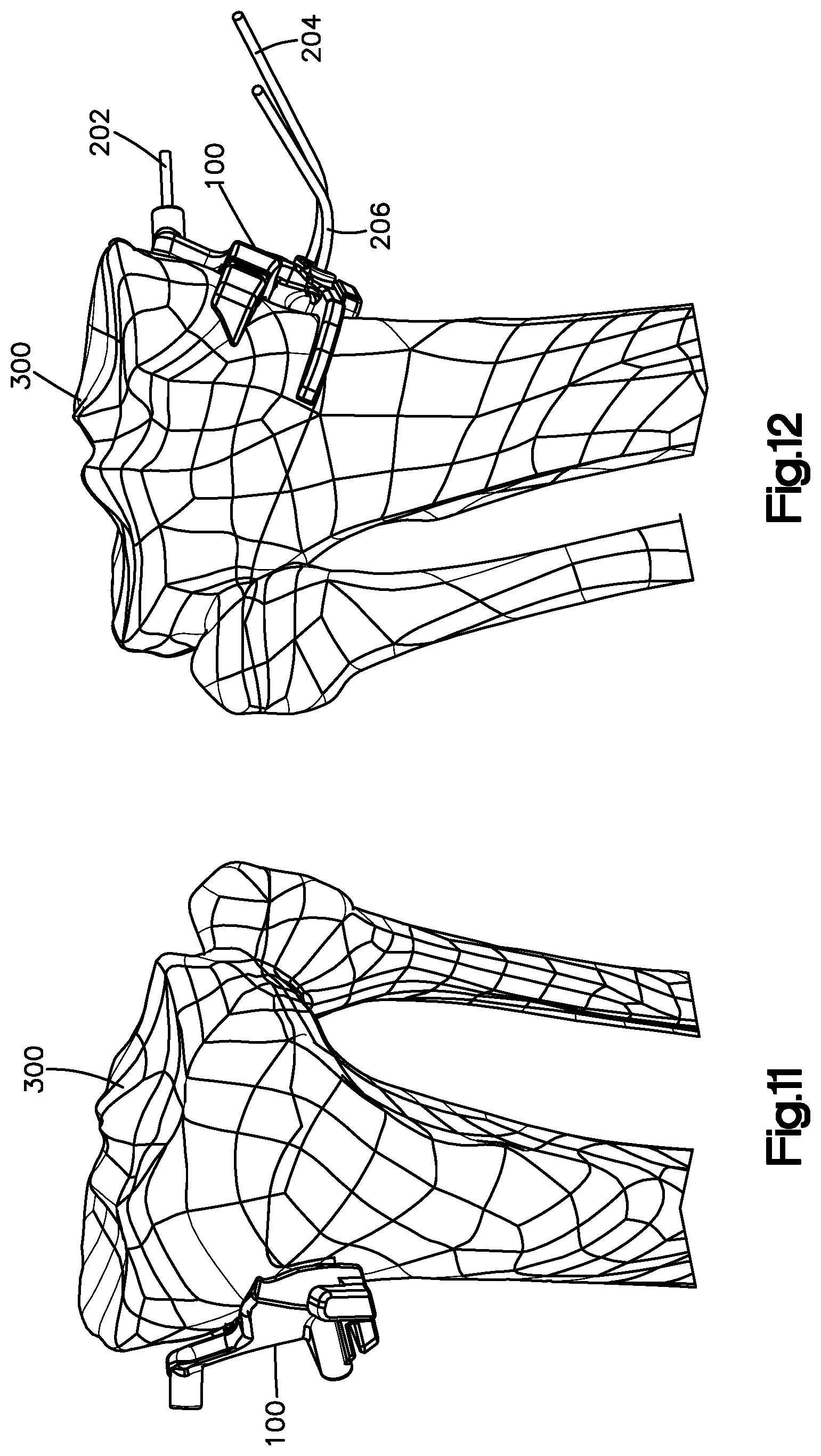 Patent US12324591 Figure 6 – Osteotomy guide