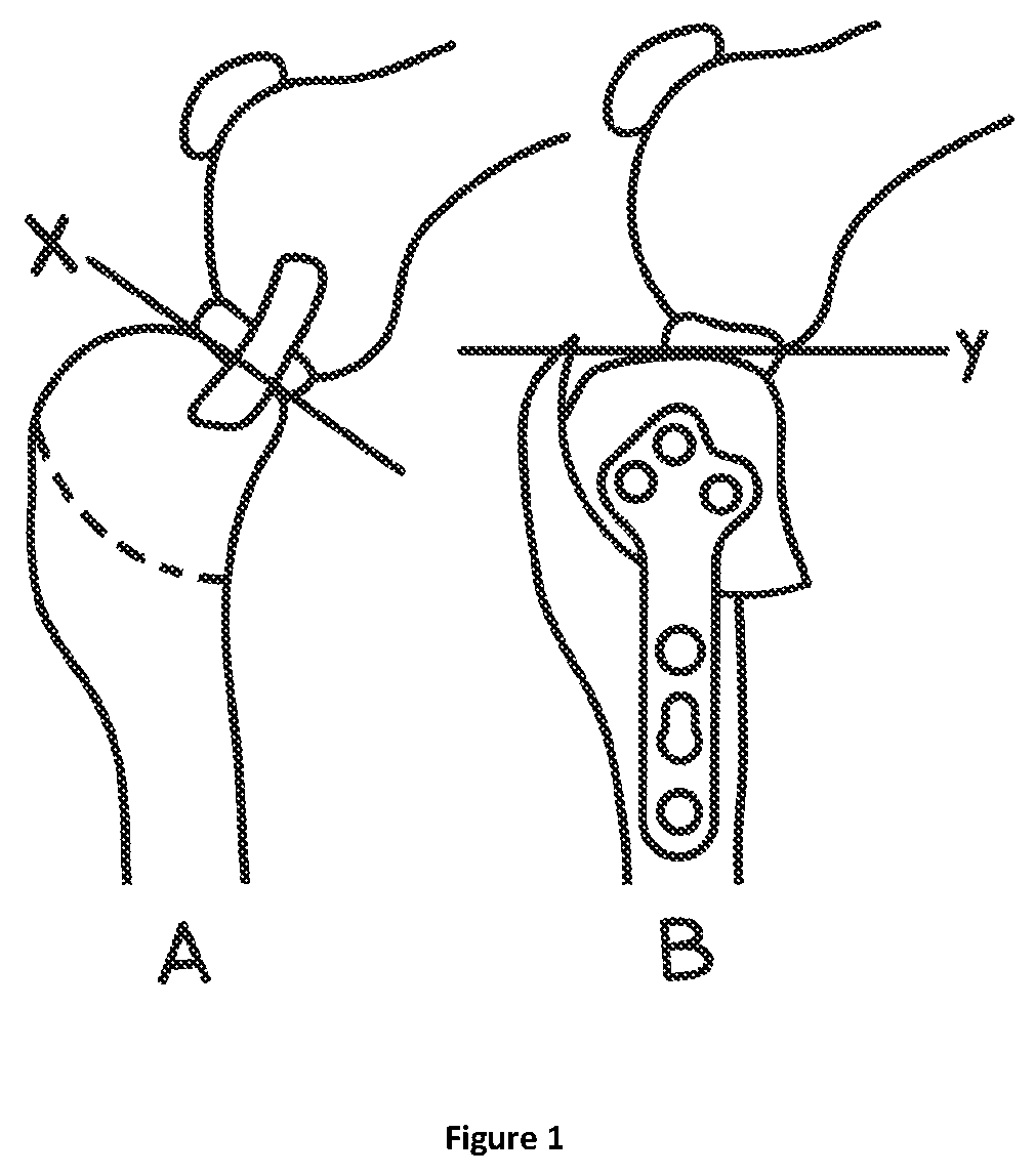 Patent US12324592 Figure 1 – Veterinary surgical guide