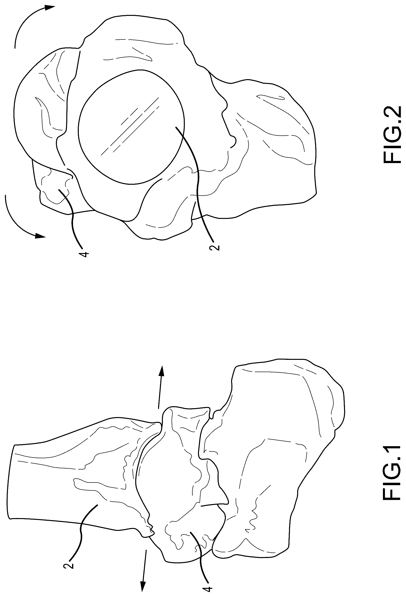Patent US12324597 Figure 1 – Methods and systems for arthroplasty