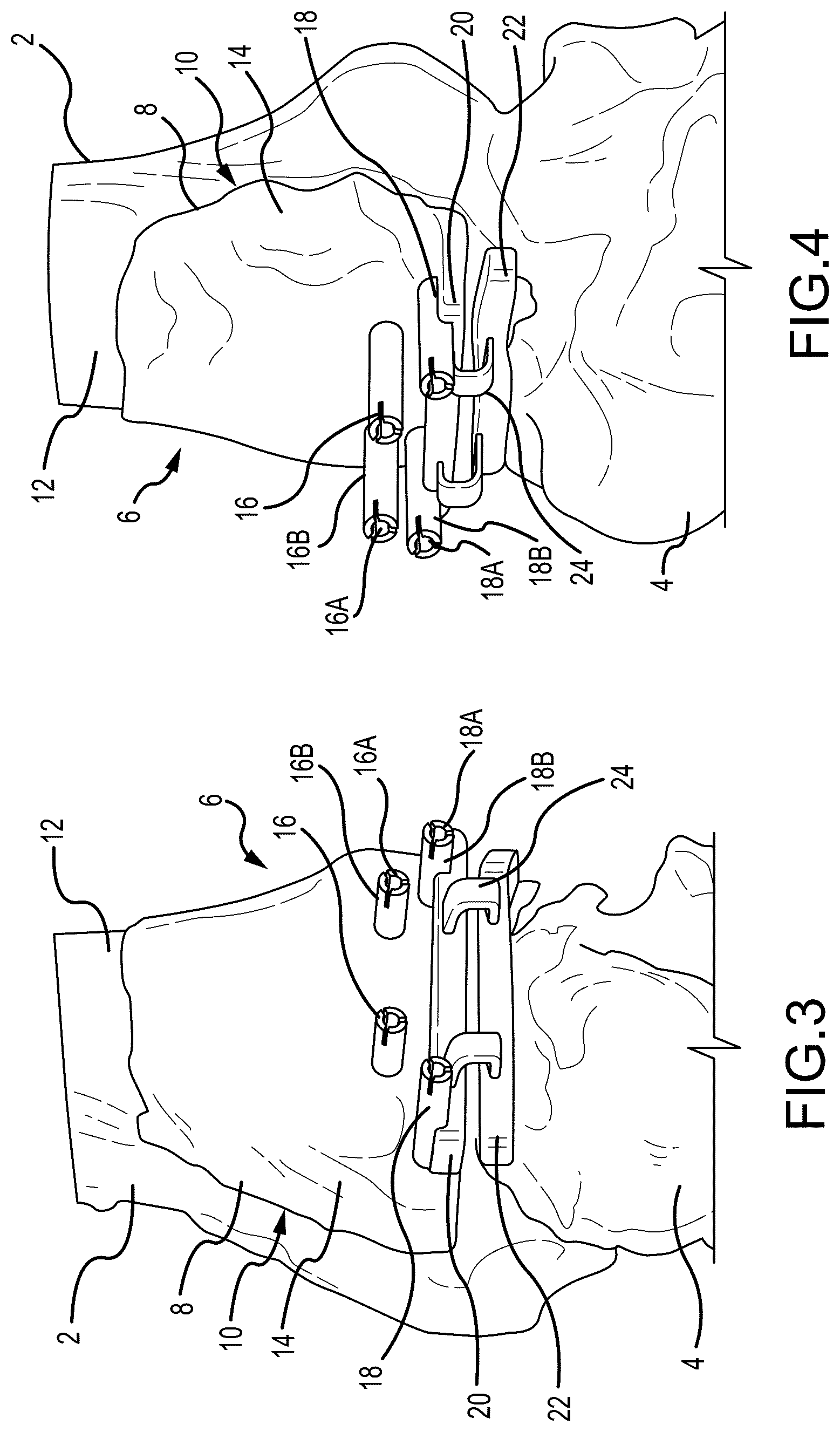 Patent US12324597 Figure 2 – Methods and systems for arthroplasty