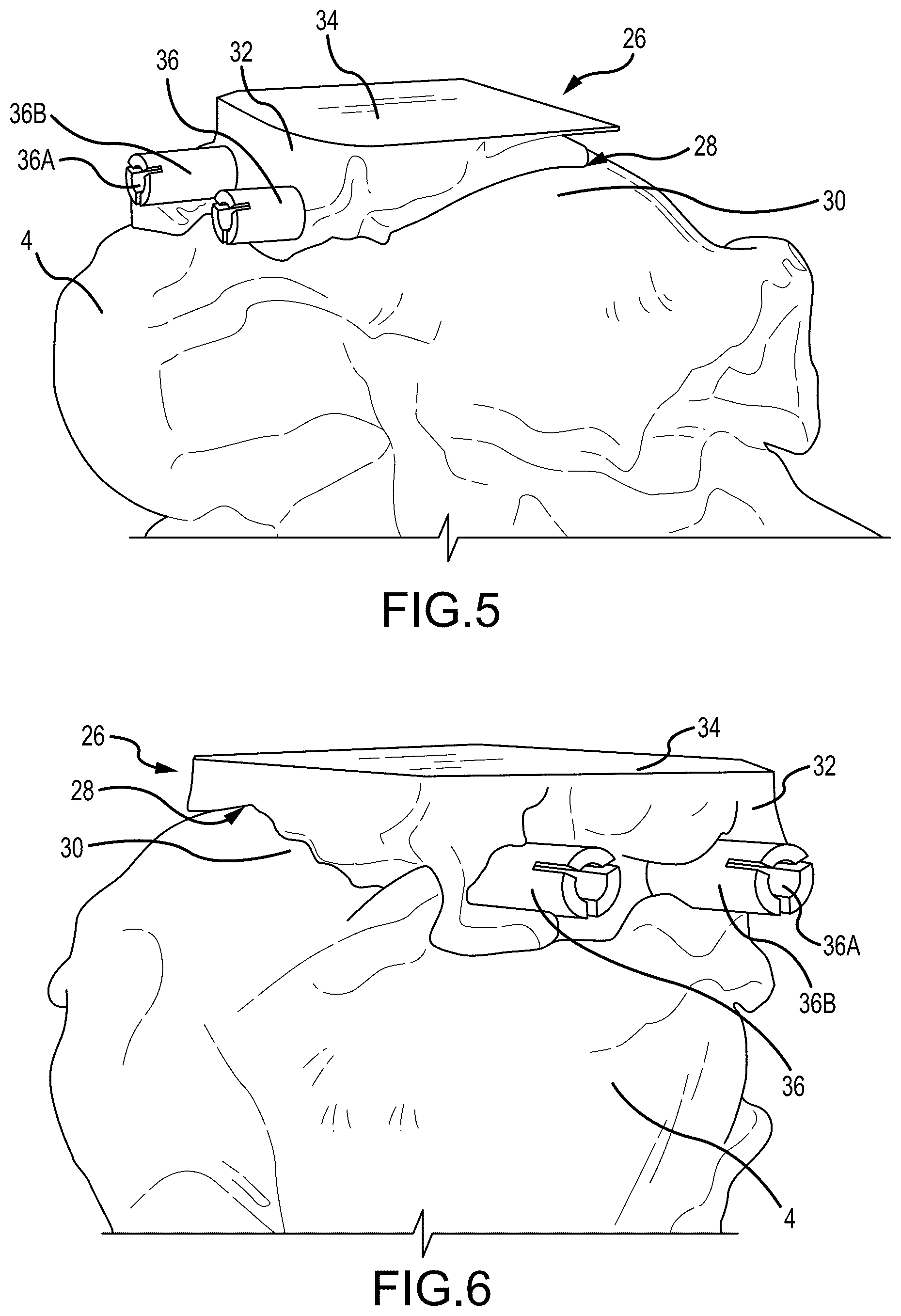 Patent US12324597 Figure 3 – Methods and systems for arthroplasty