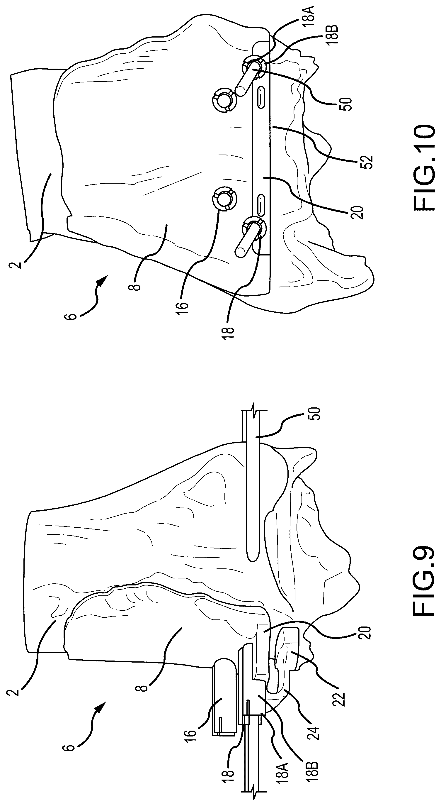 Patent US12324597 Figure 5 – Methods and systems for arthroplasty