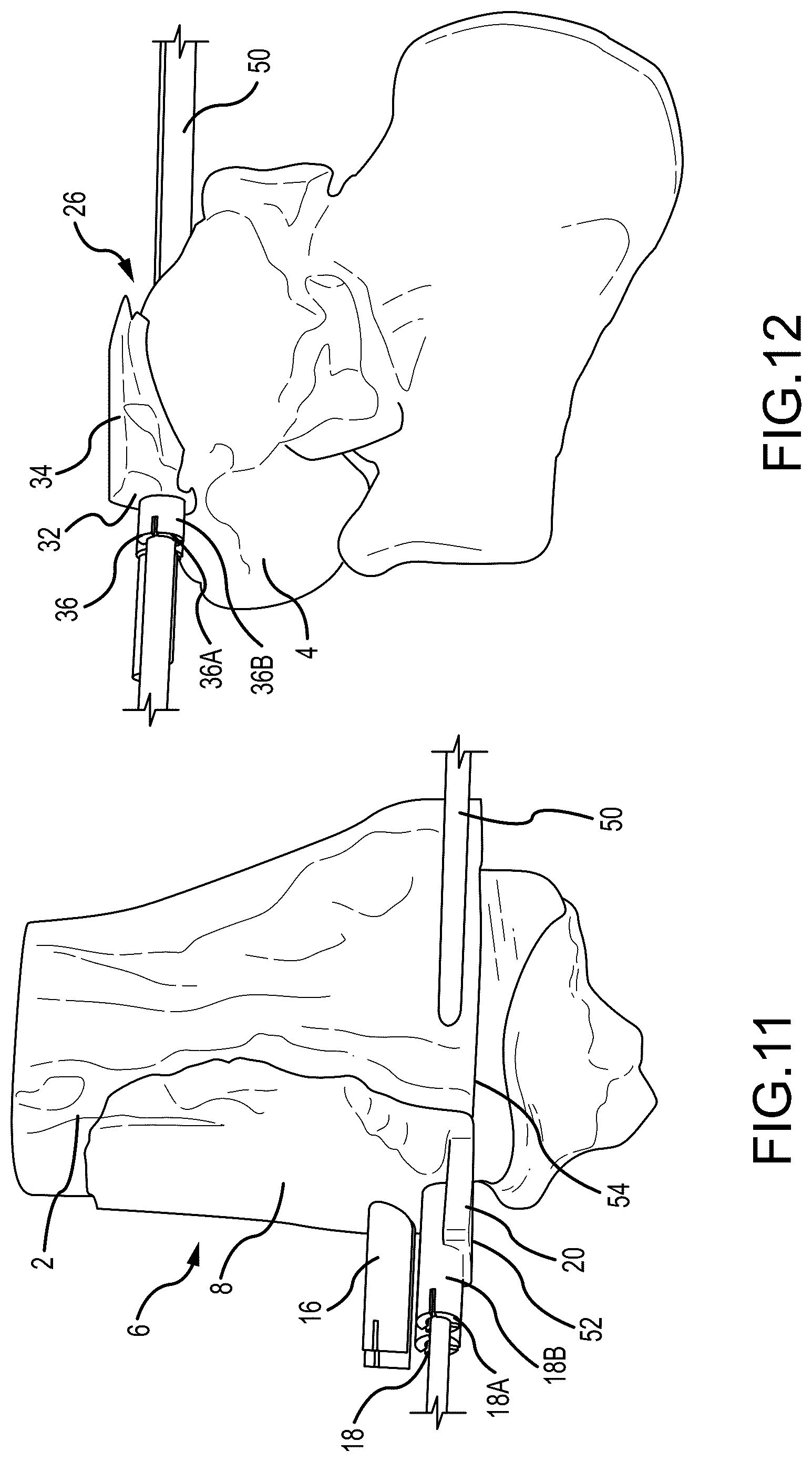 Patent US12324597 Figure 6 – Methods and systems for arthroplasty