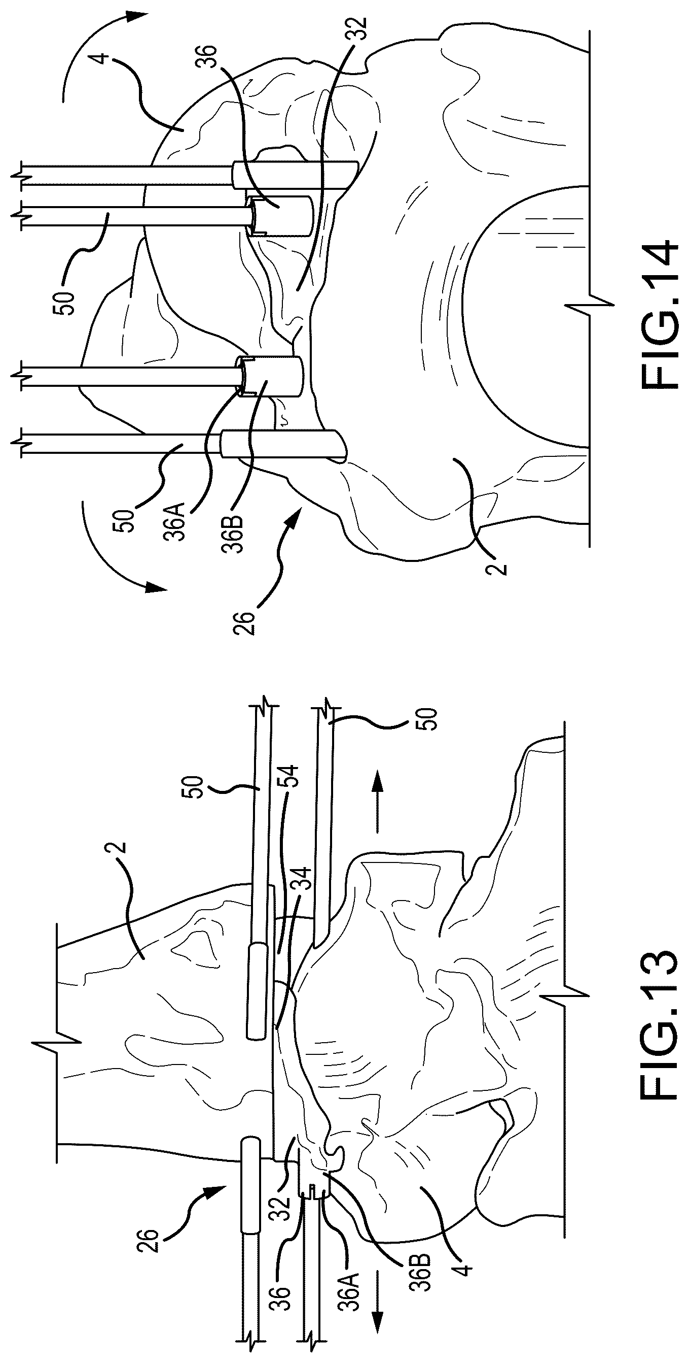 Patent US12324597 Figure 7 – Methods and systems for arthroplasty