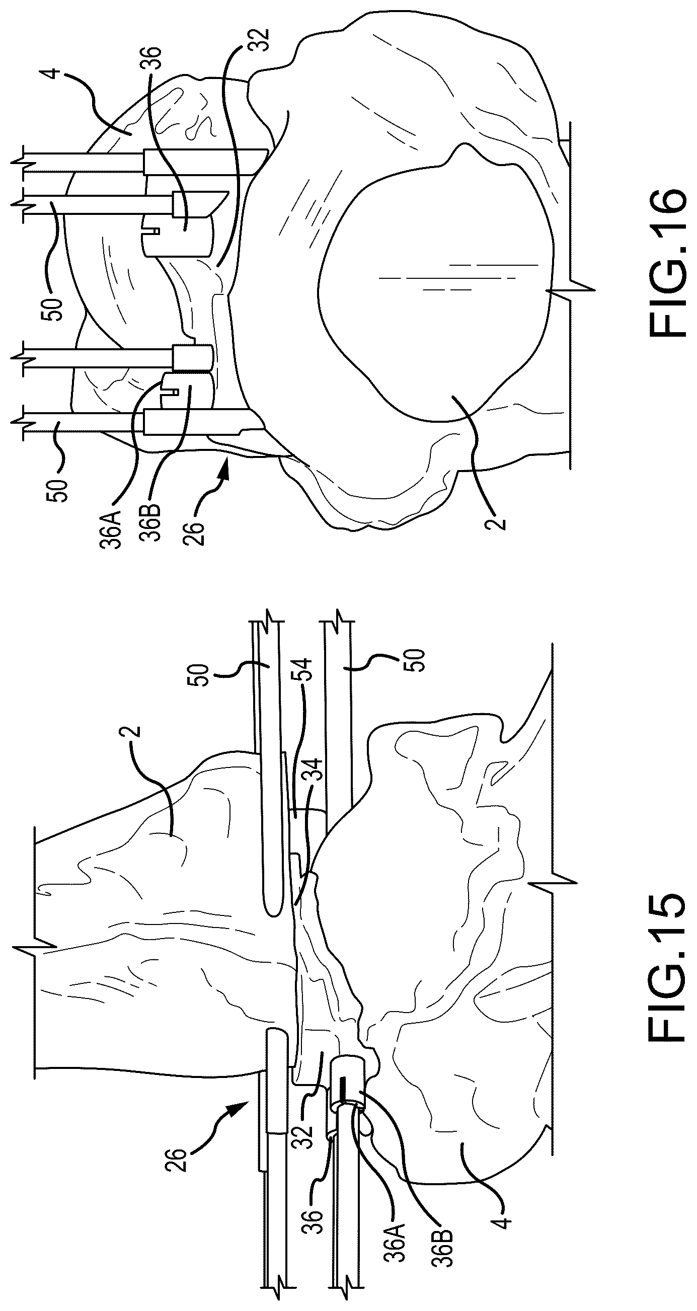 Patent US12324597 Figure 8 – Methods and systems for arthroplasty