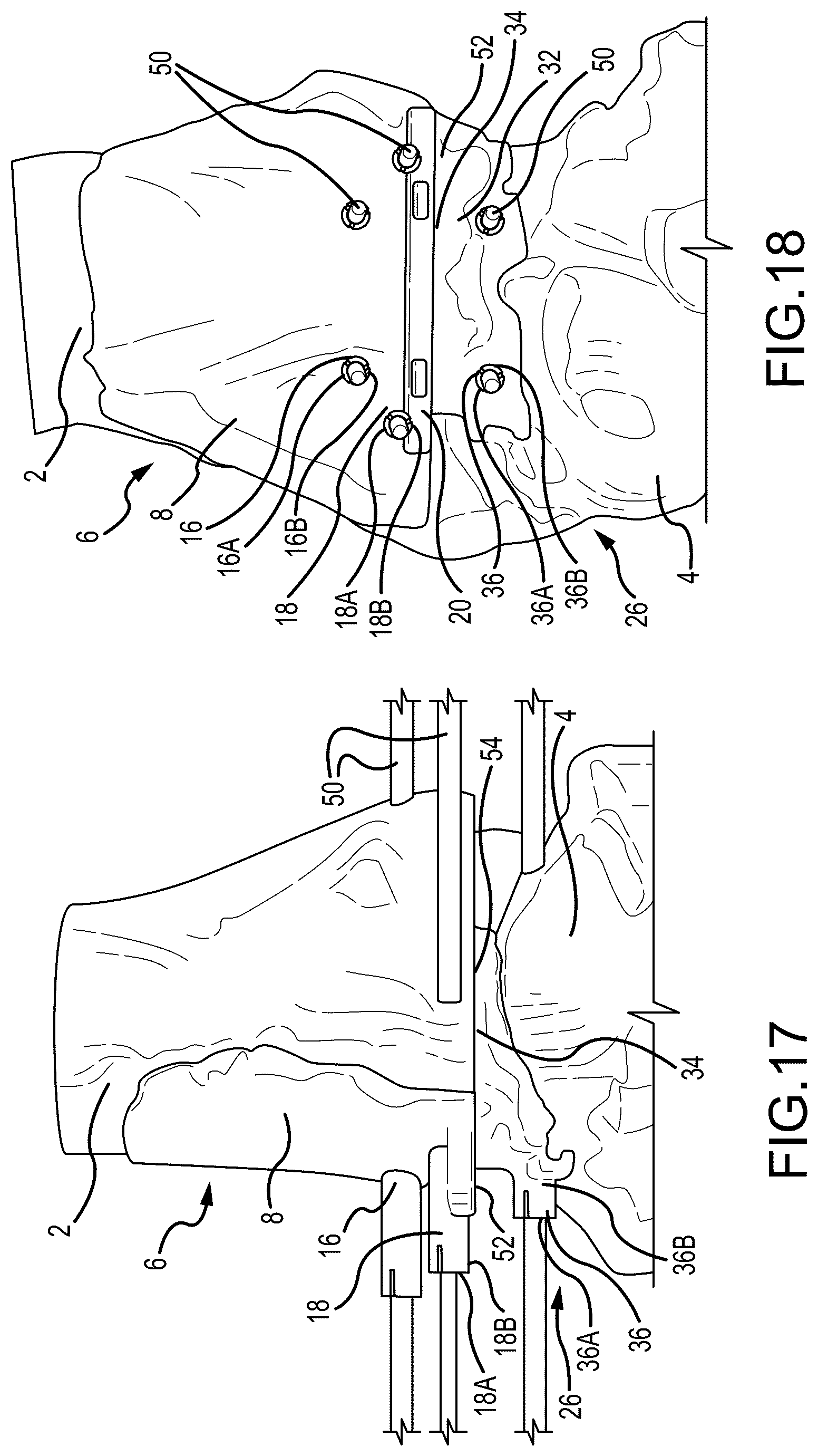 Patent US12324597 Figure 9 – Methods and systems for arthroplasty