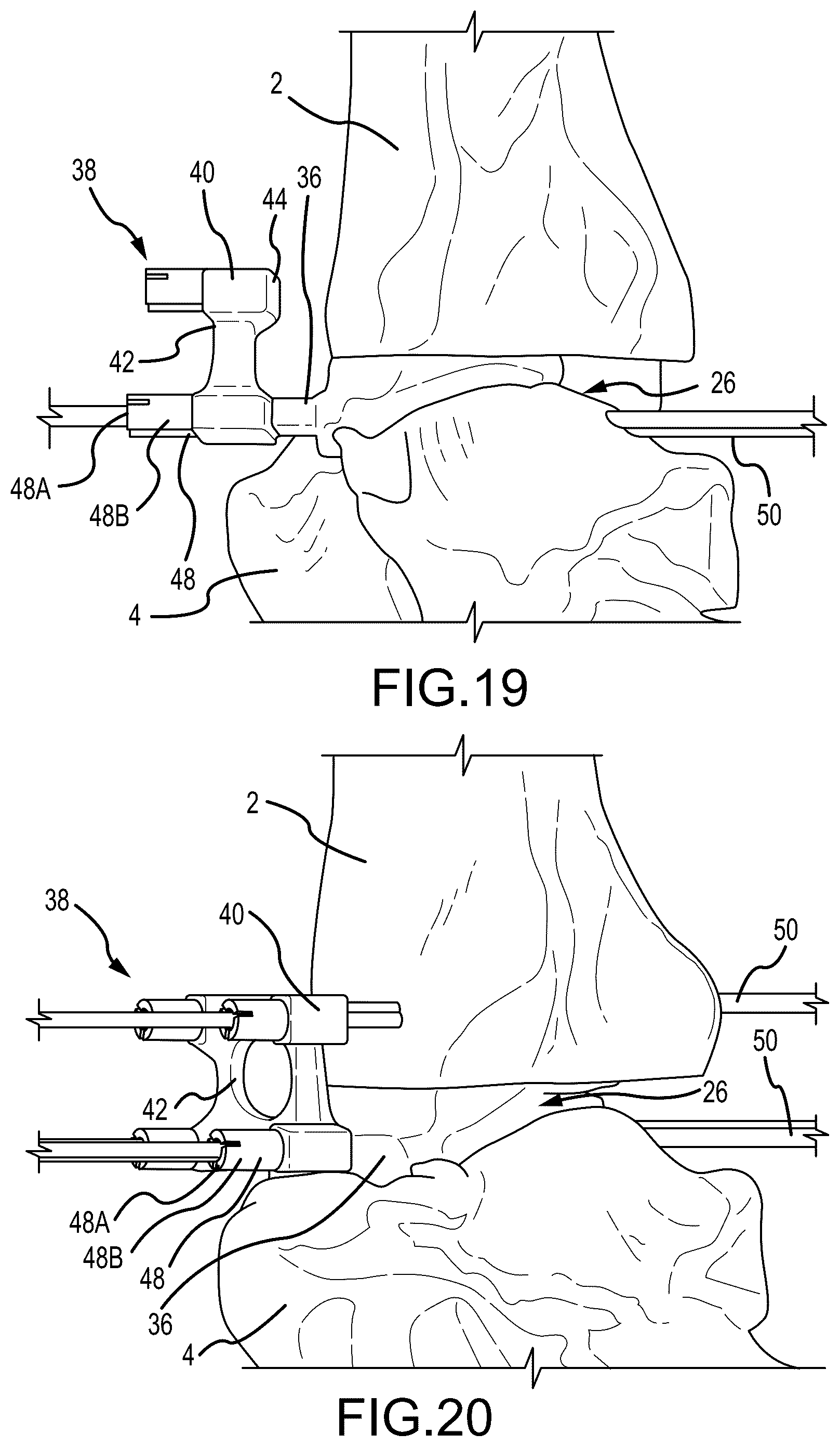 Patent US12324597 Figure 10 – Methods and systems for arthroplasty