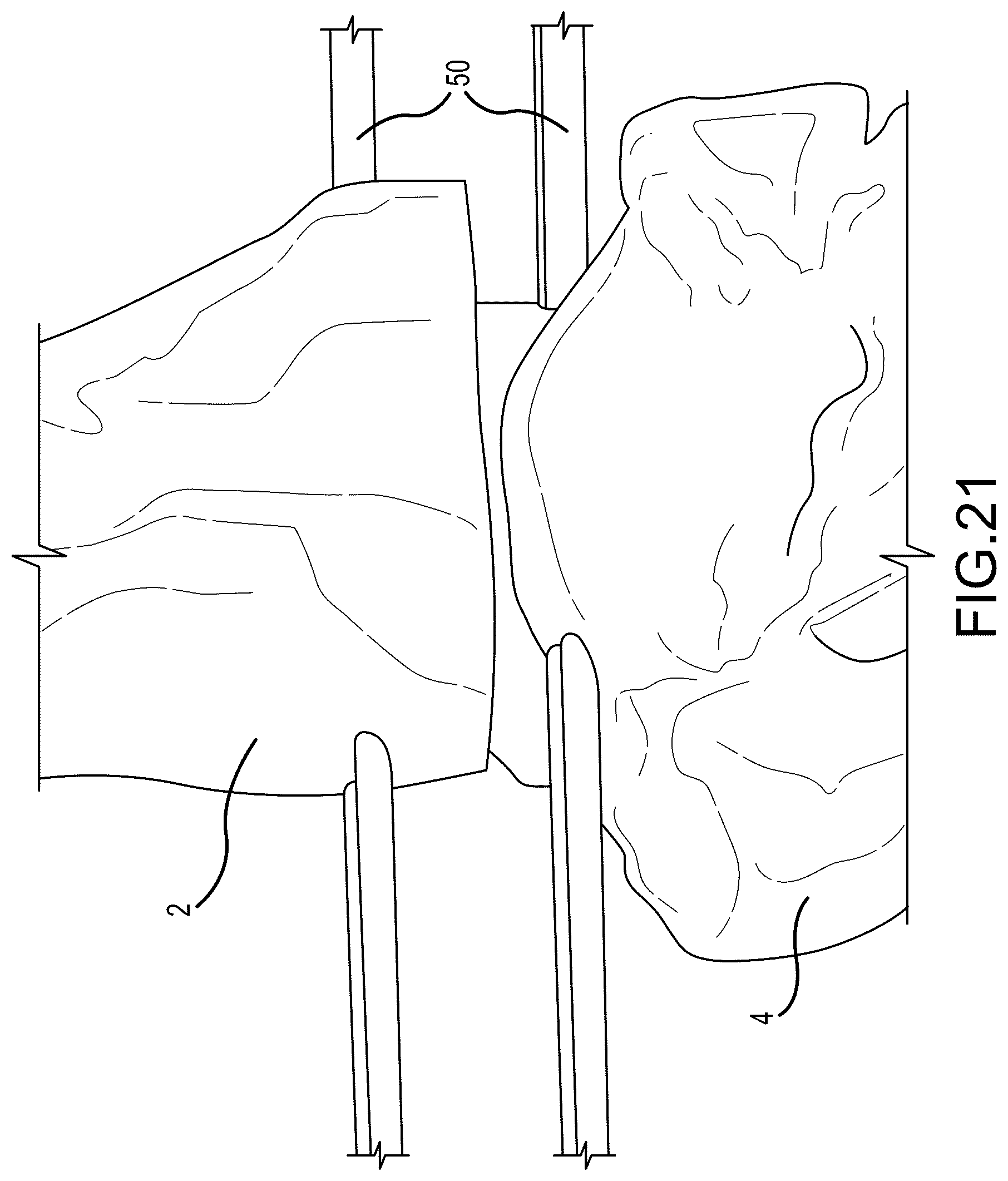 Patent US12324597 Figure 11 – Methods and systems for arthroplasty