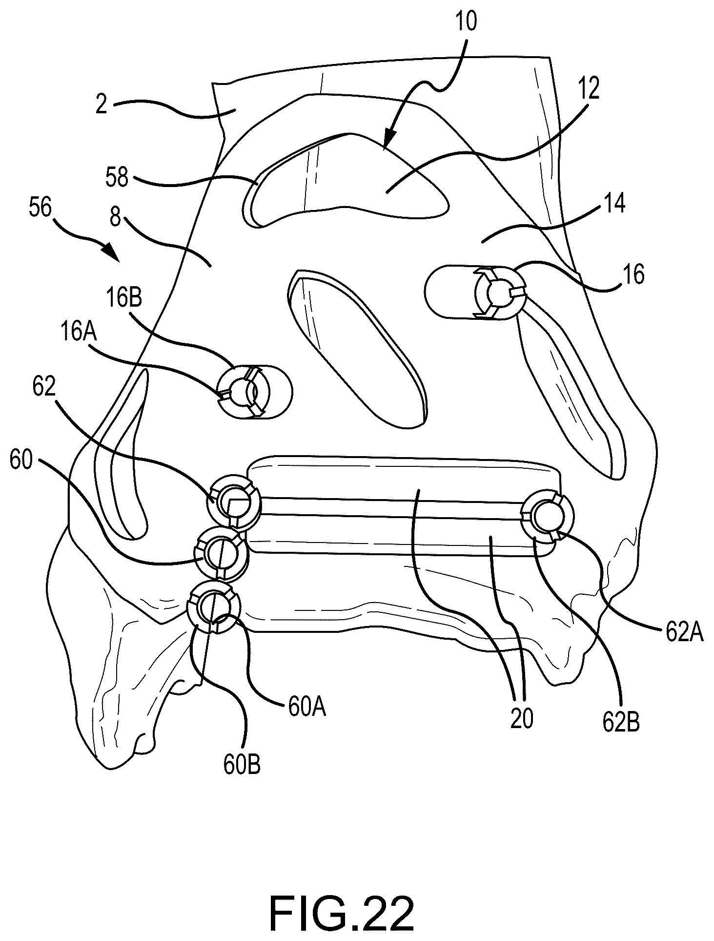 Patent US12324597 Figure 12 – Methods and systems for arthroplasty