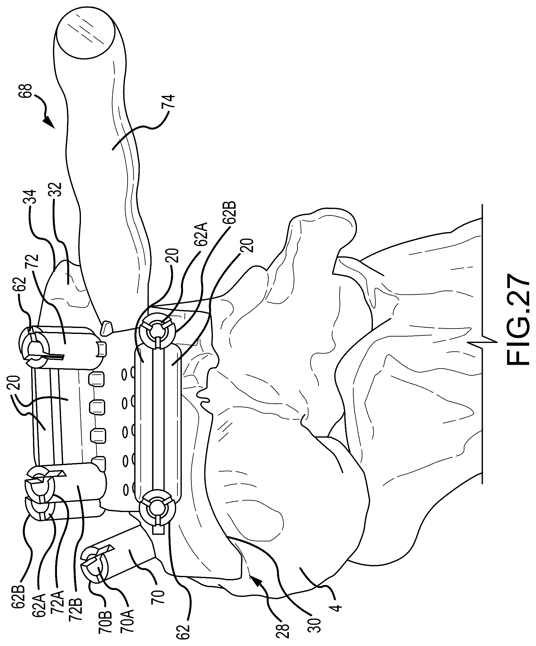 Patent US12324597 Figure 16 – Methods and systems for arthroplasty