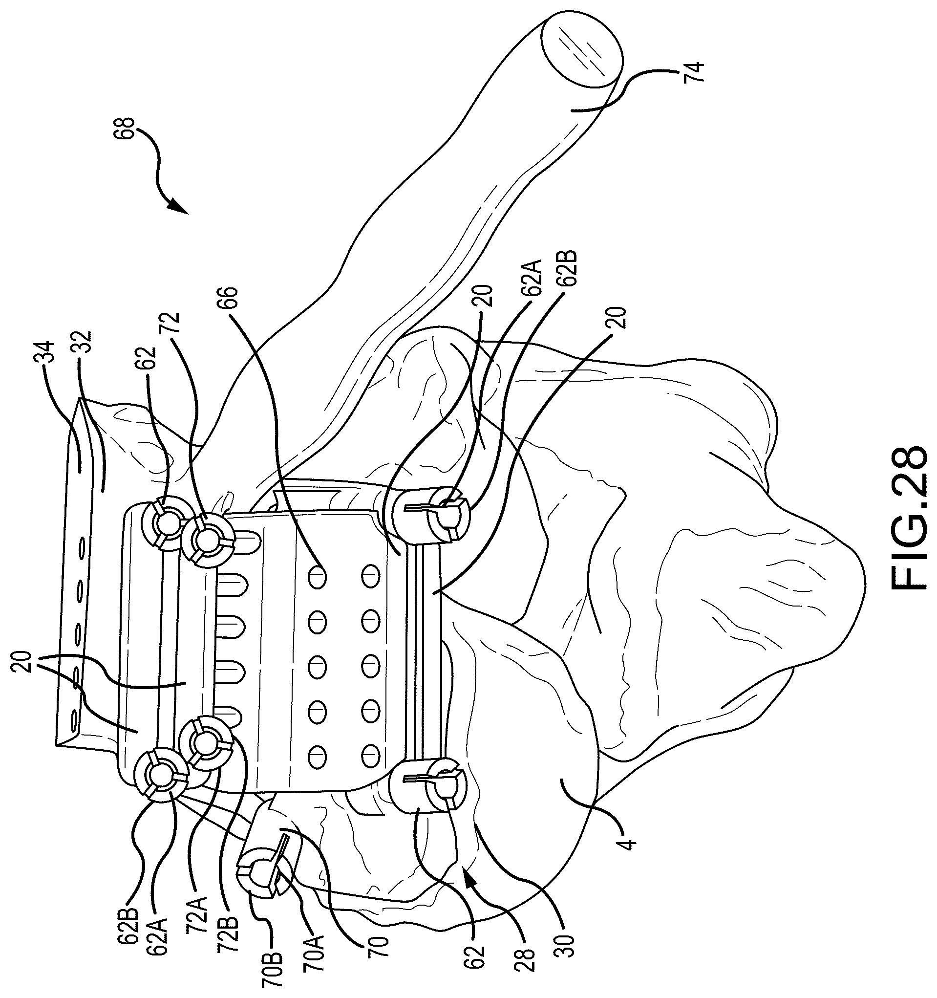 Patent US12324597 Figure 17 – Methods and systems for arthroplasty