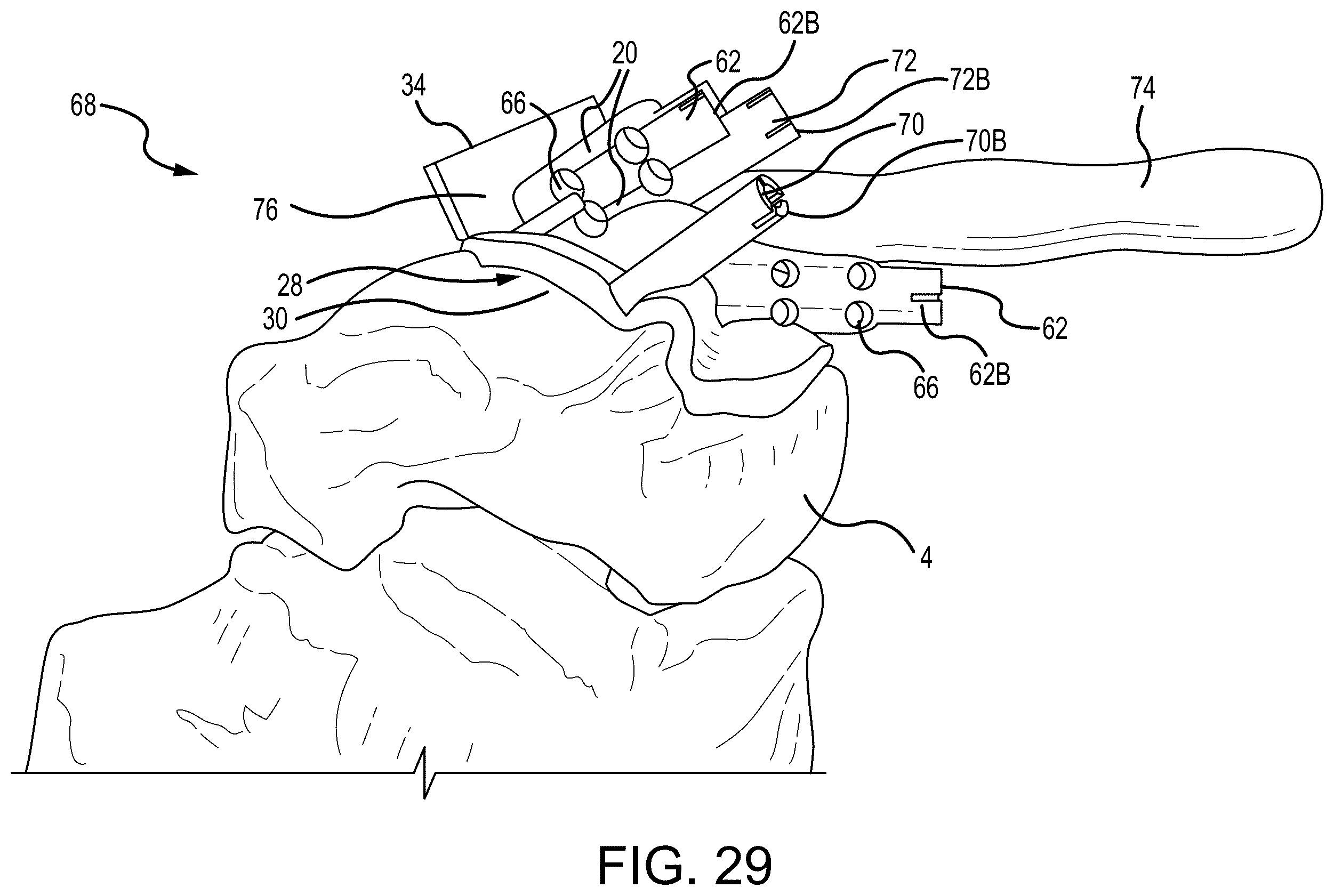 Patent US12324597 Figure 18 – Methods and systems for arthroplasty