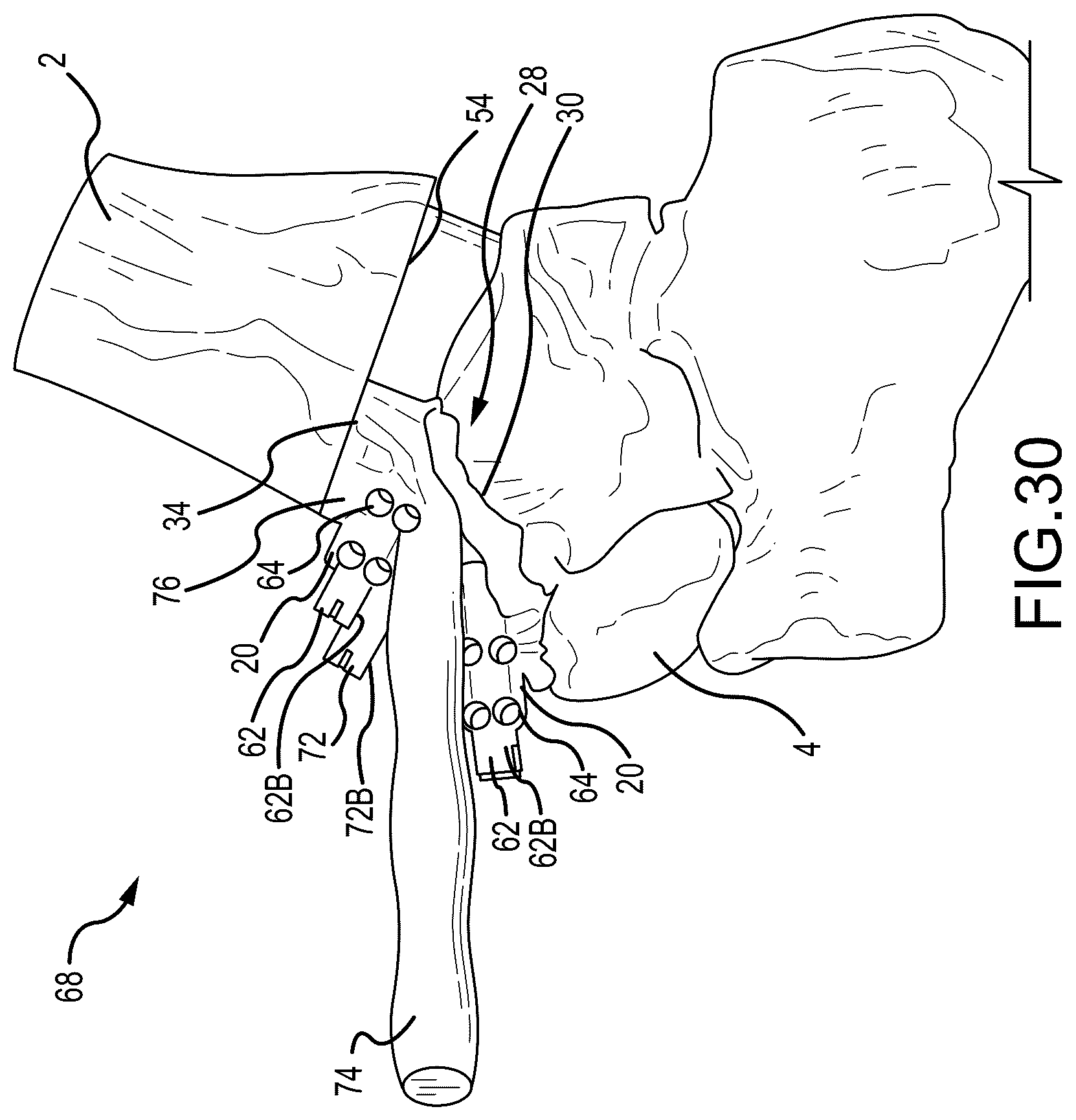 Patent US12324597 Figure 19 – Methods and systems for arthroplasty