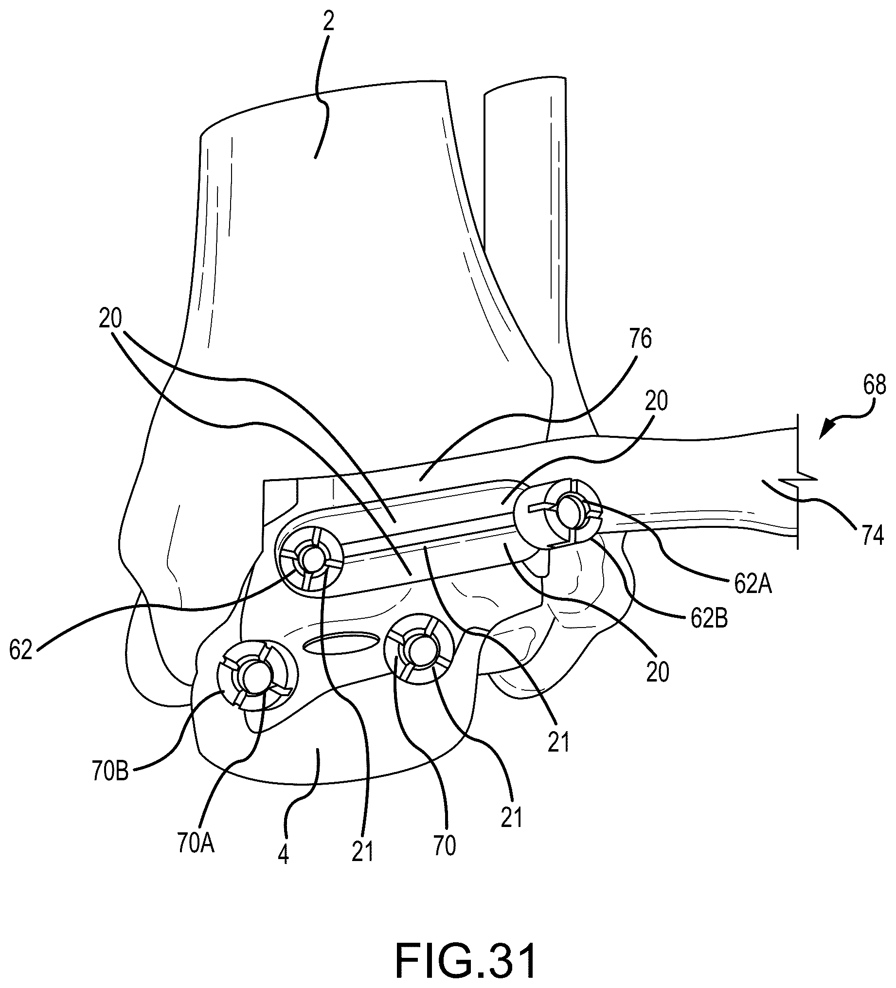 Patent US12324597 Figure 20 – Methods and systems for arthroplasty