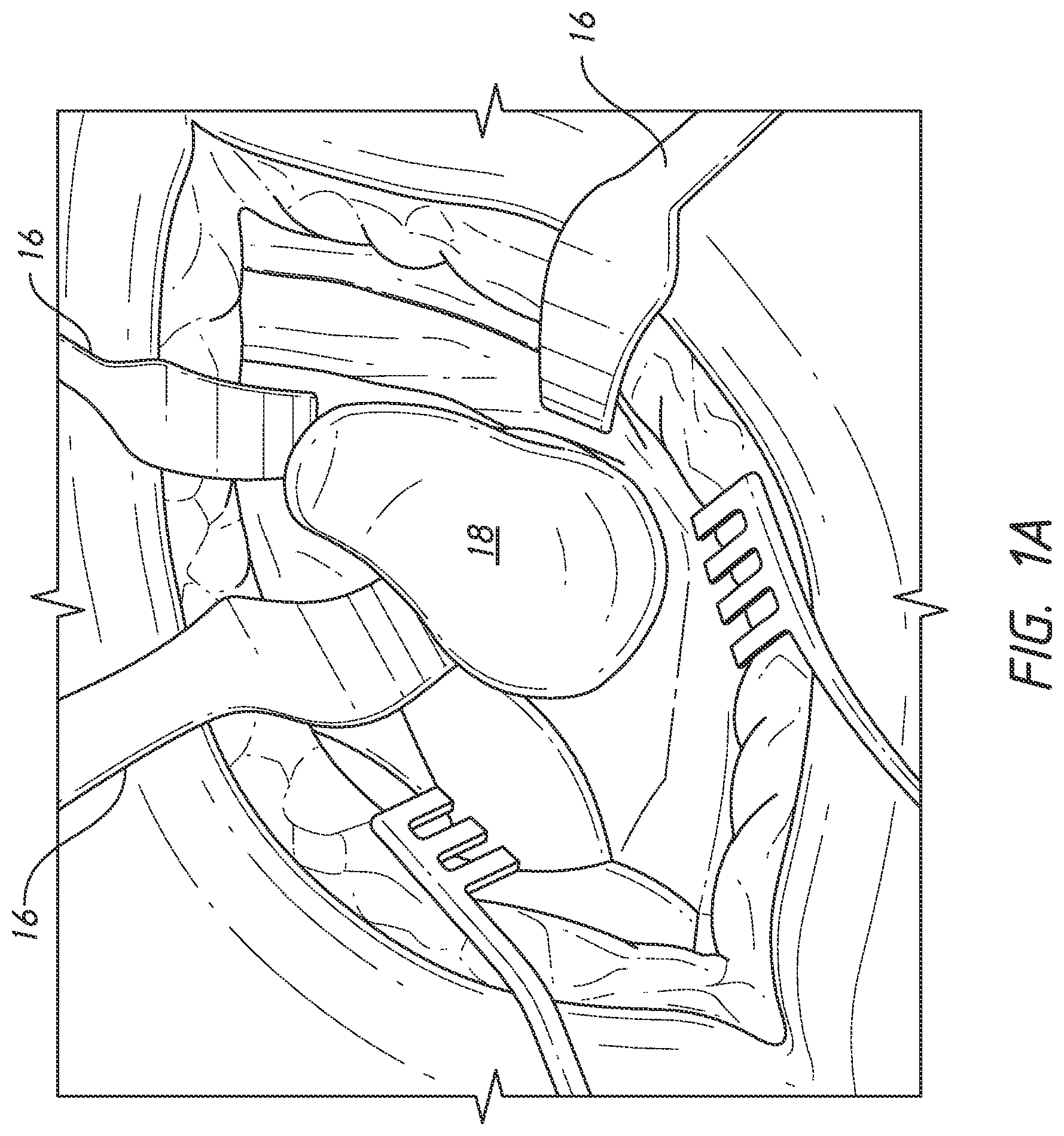 Patent US12324598 Figure 2 – Guides and instruments for improving accuracy of glenoid implant placement