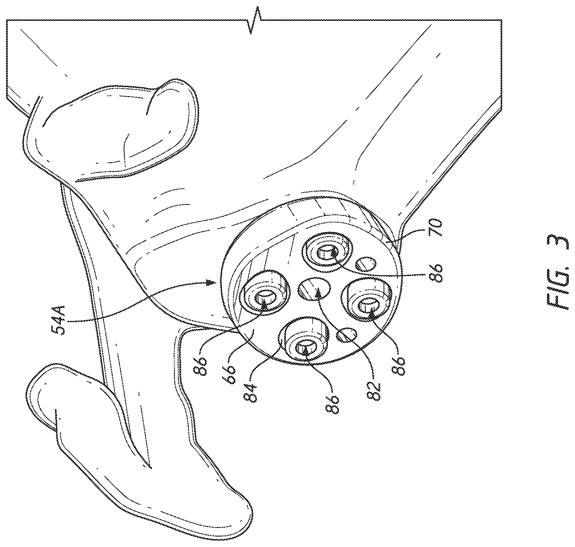 Patent US12324598 Figure 4 – Guides and instruments for improving accuracy of glenoid implant placement