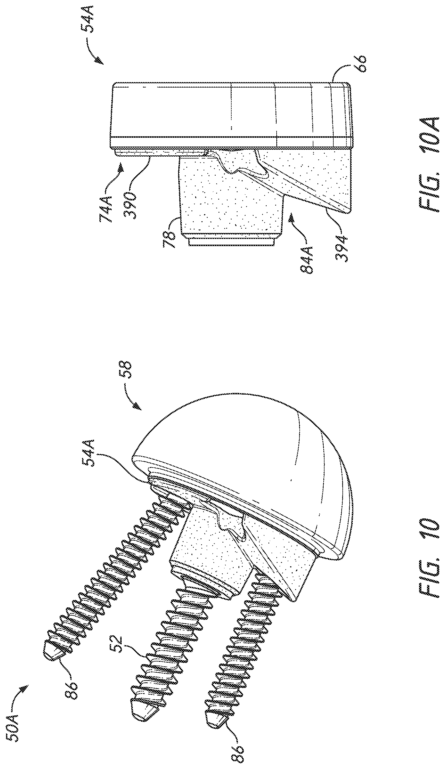Patent US12324598 Figure 17 – Guides and instruments for improving accuracy of glenoid implant placement