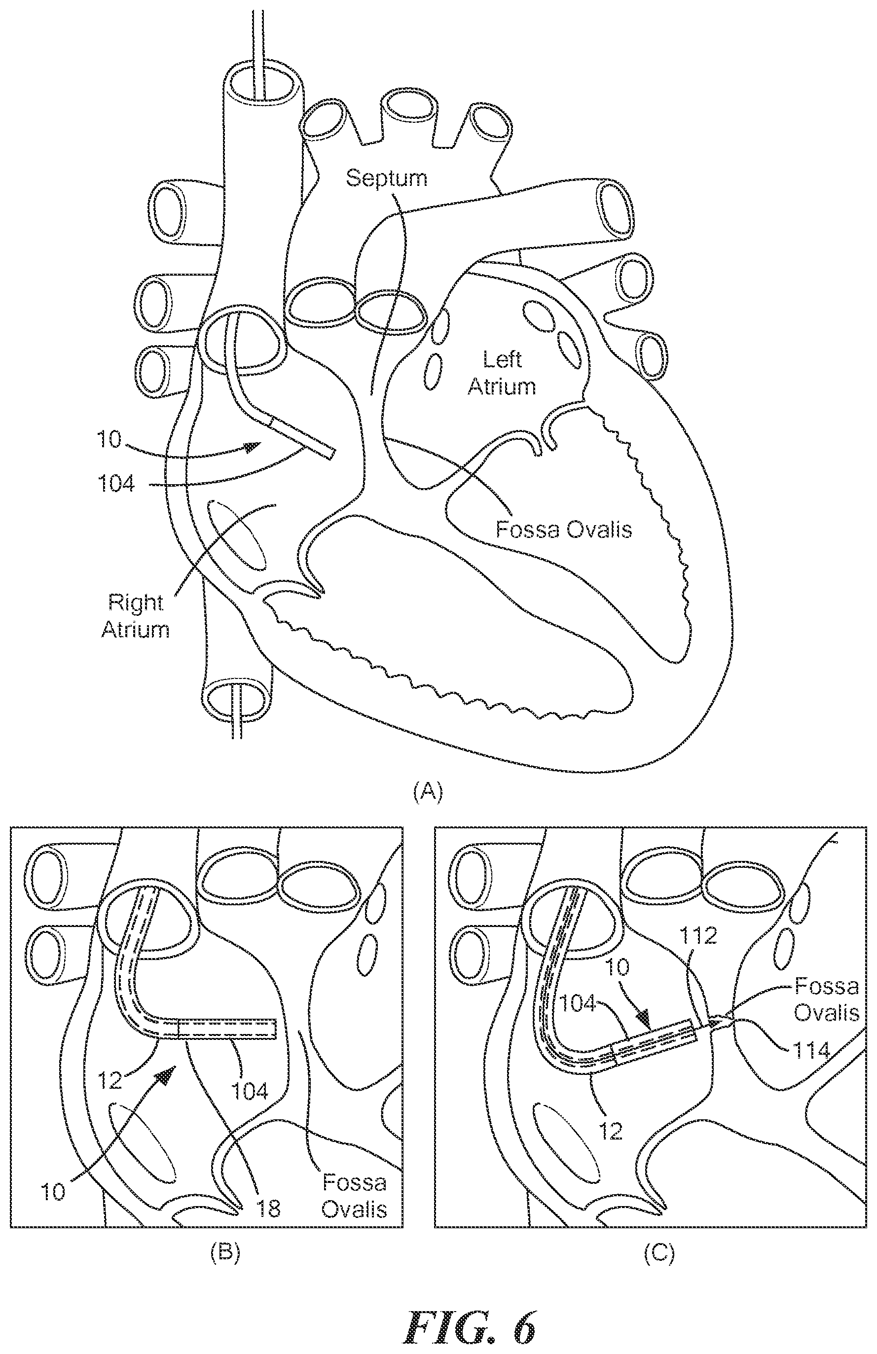 Patent US12324601 Figure 6 – Interatrial septoplasty cutting device