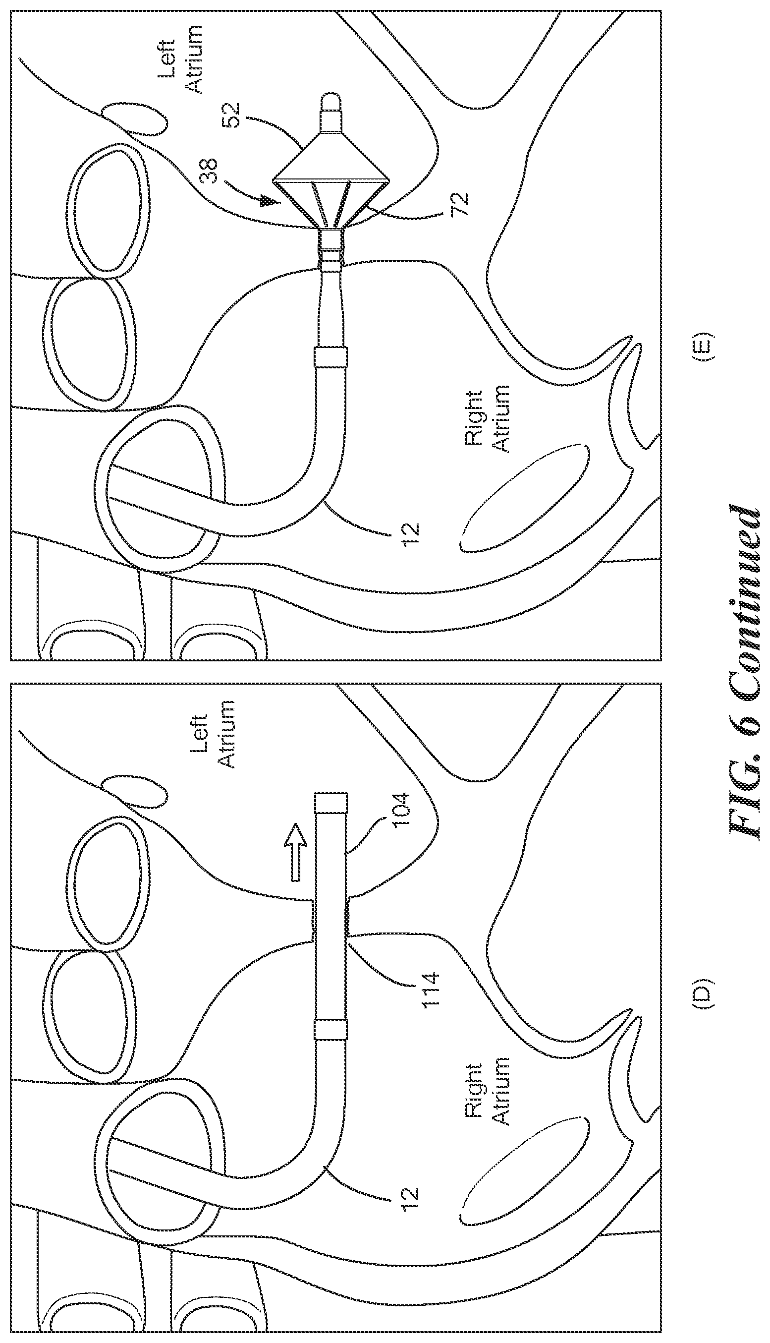 Patent US12324601 Figure 7 – Interatrial septoplasty cutting device
