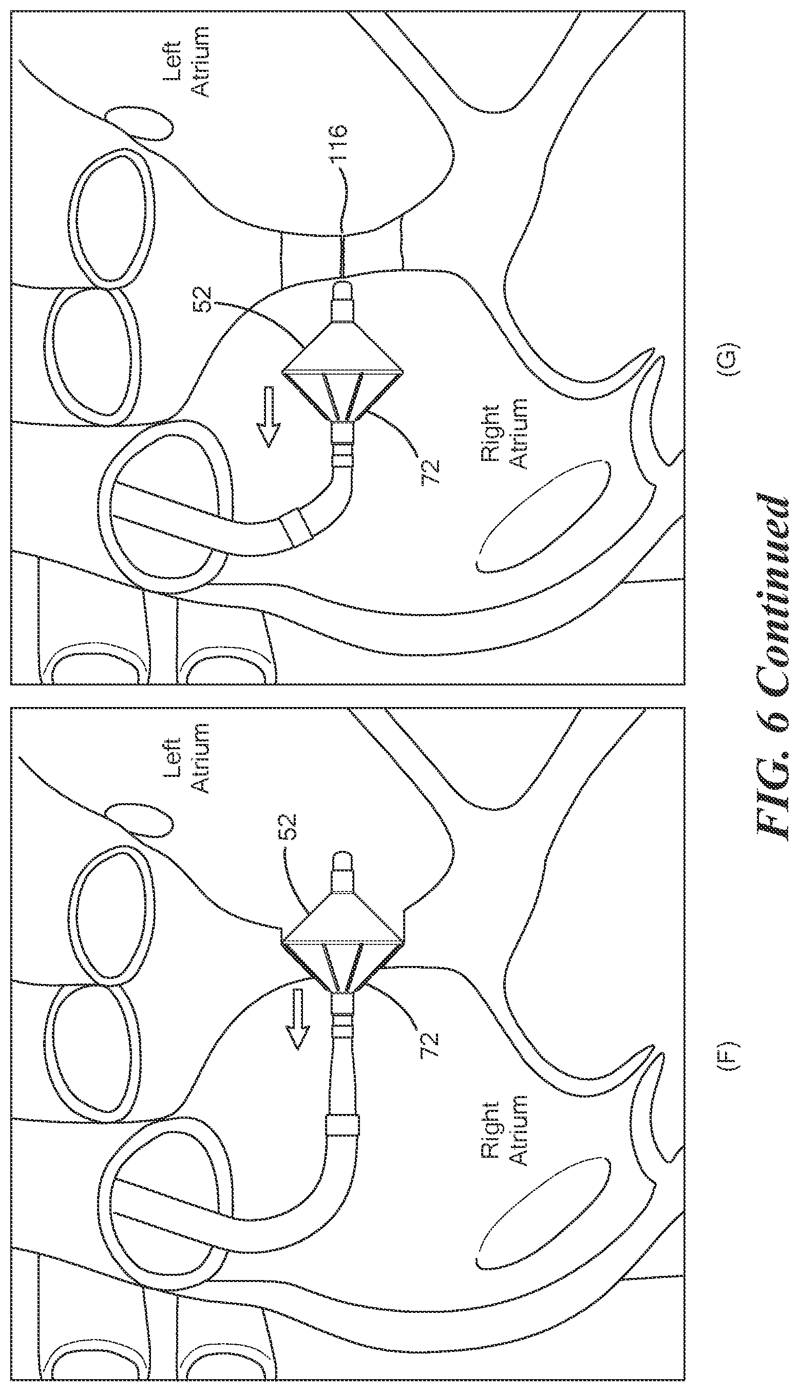 Patent US12324601 Figure 8 – Interatrial septoplasty cutting device