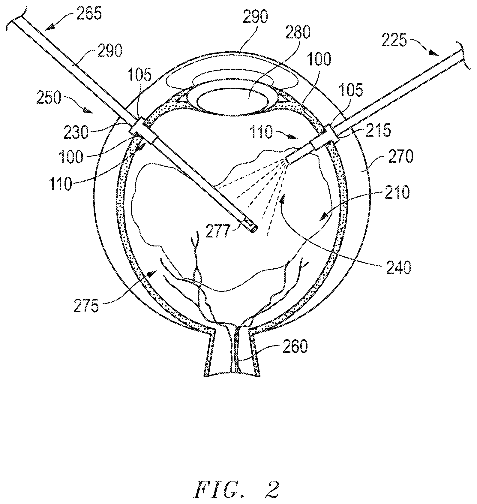 Patent US12324605 Figure 2 – Force fit eye cannula with augmented surface