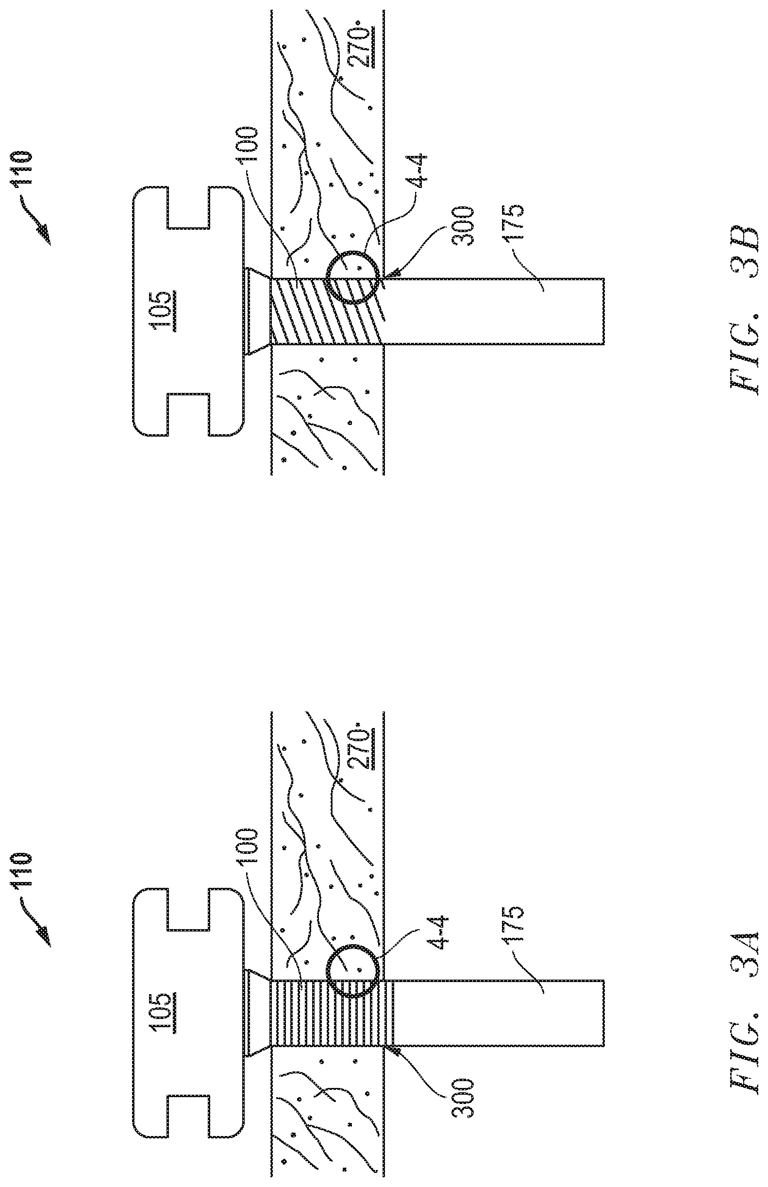 Patent US12324605 Figure 3 – Force fit eye cannula with augmented surface