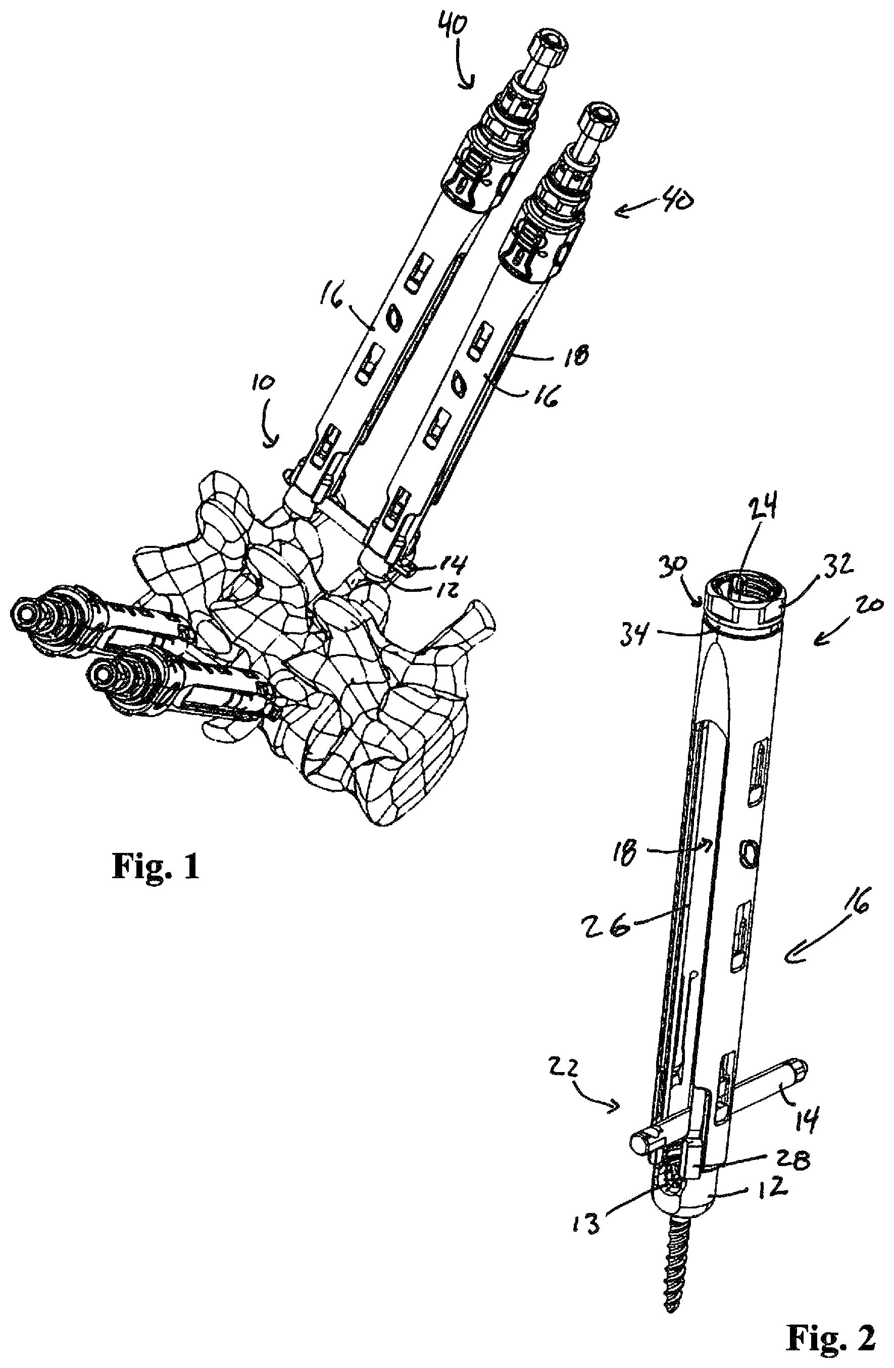 Patent US12324611 Figure 1 – Spinal fixation system