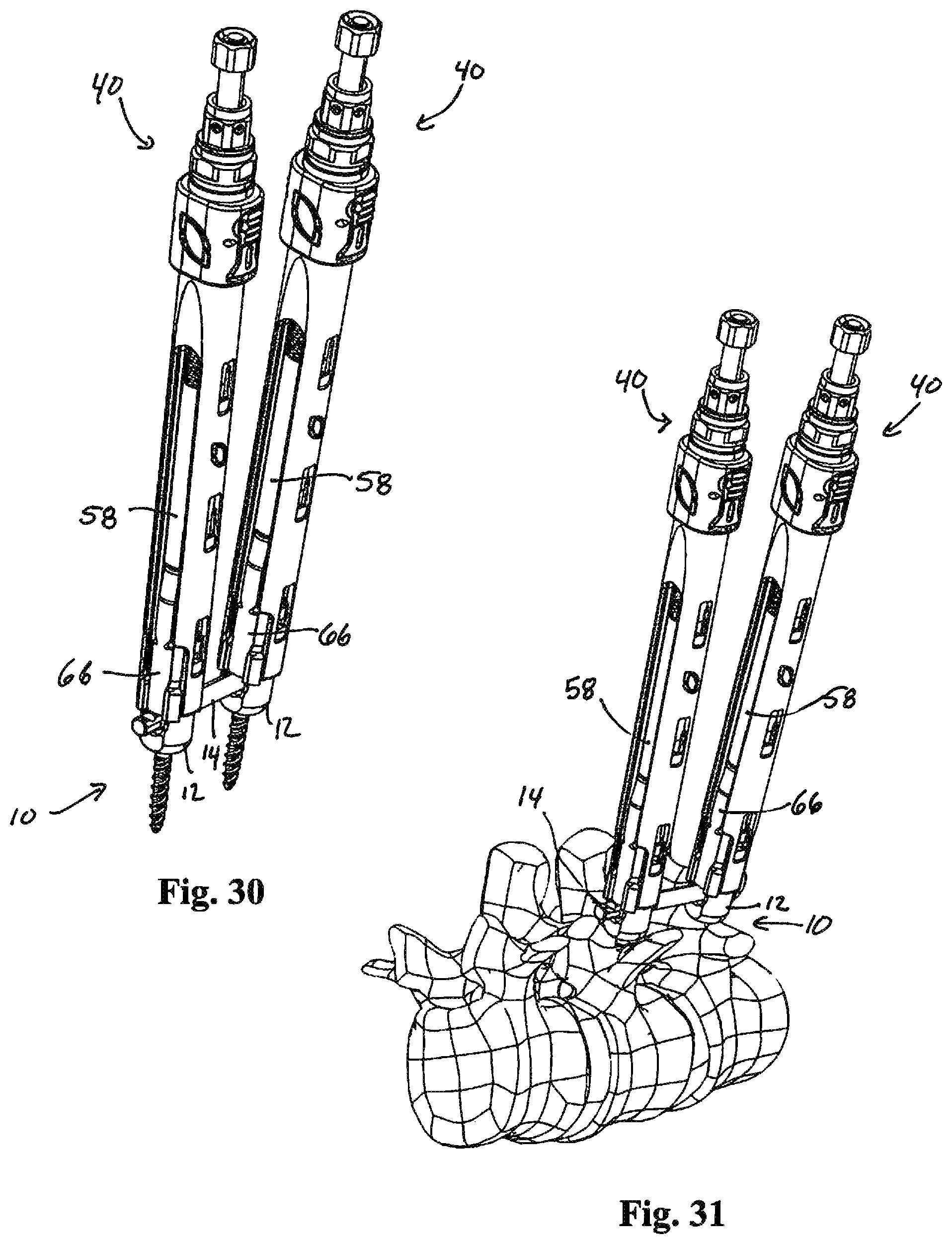 Patent US12324611 Figure 12 – Spinal fixation system