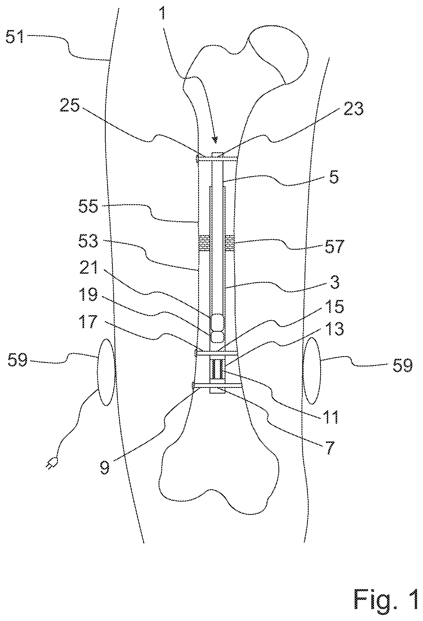 Patent US12324612 Figure 1 – Intramedullary nail for distracting a long bone