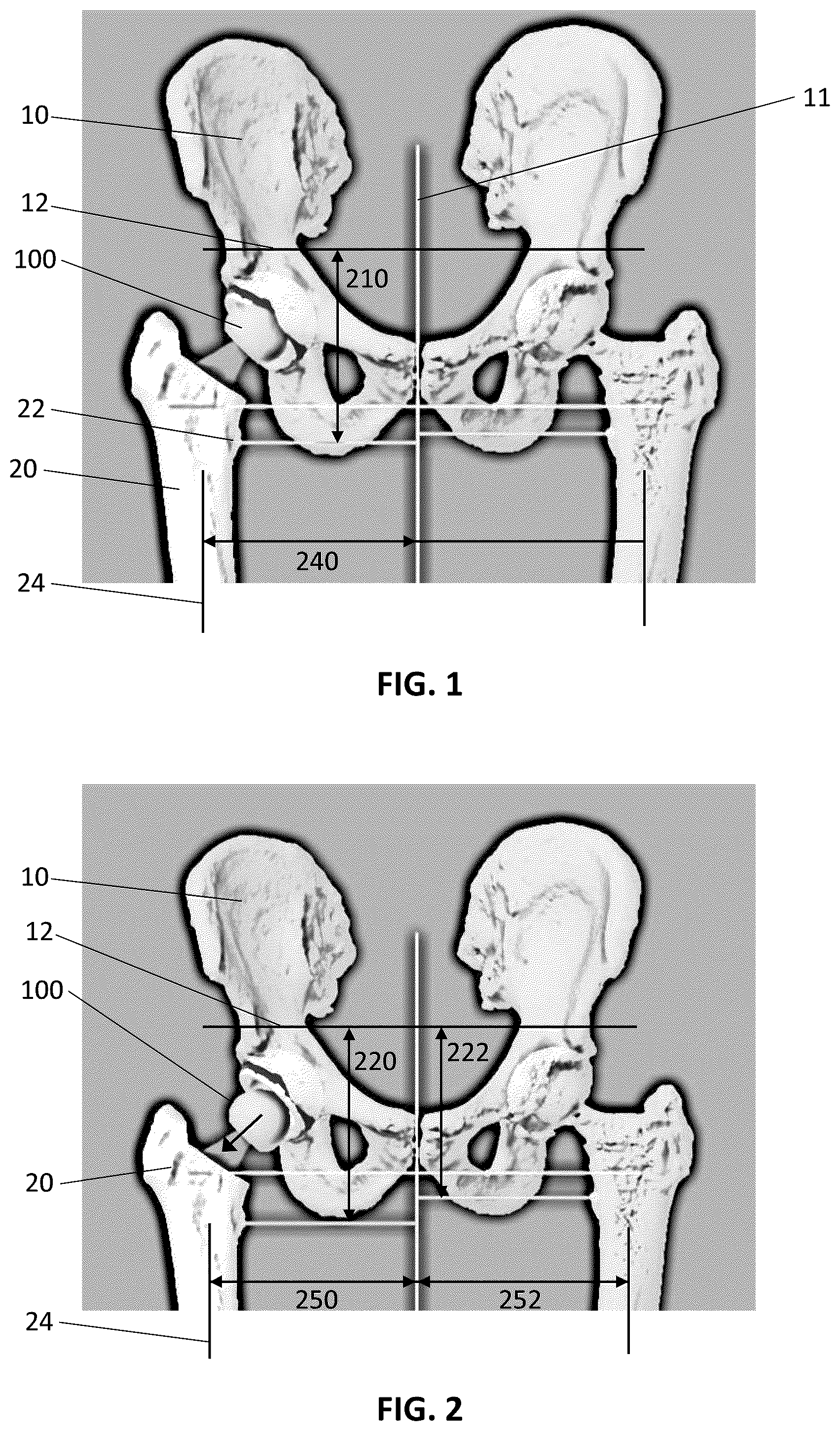 Patent US12324615 Figure 1 – Assessment of soft tissue tension in hip procedures