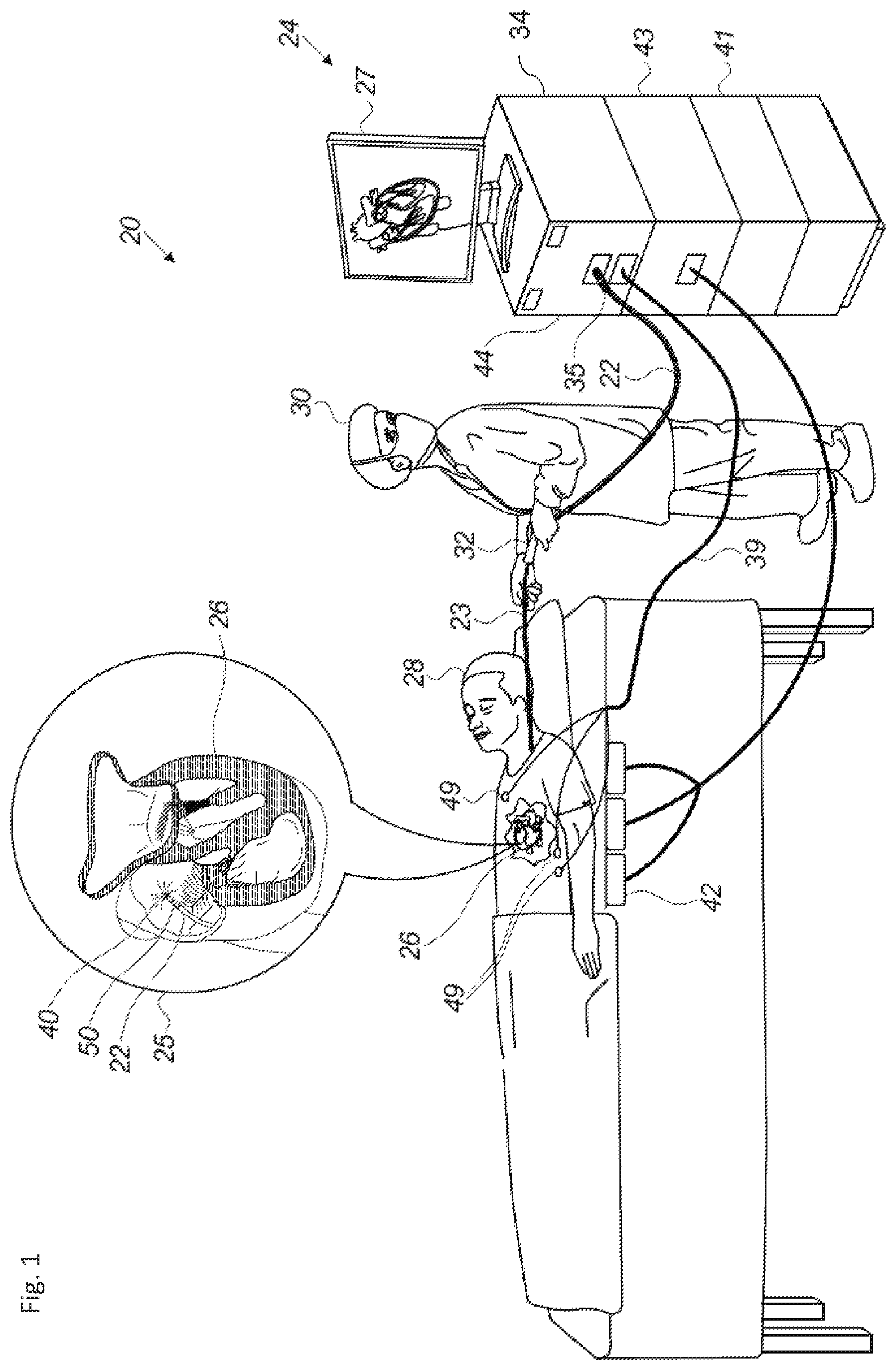 Patent US12324619 Figure 1 – Automatic anatomical feature identification and map segmentation