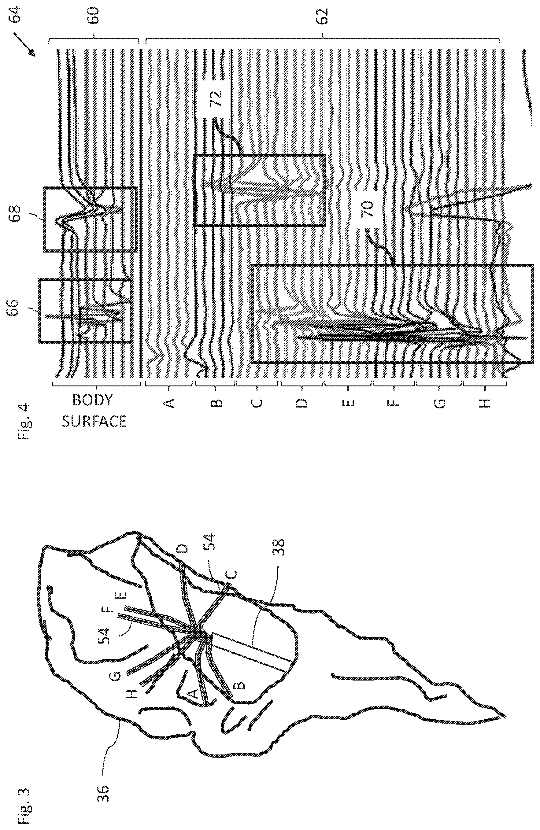 Patent US12324619 Figure 3 – Automatic anatomical feature identification and map segmentation
