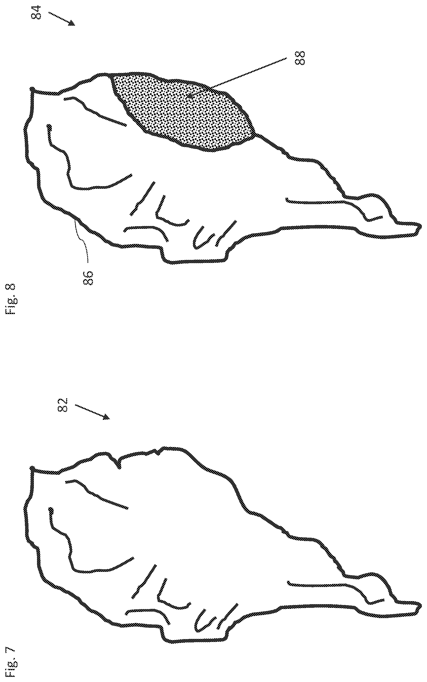 Patent US12324619 Figure 5 – Automatic anatomical feature identification and map segmentation