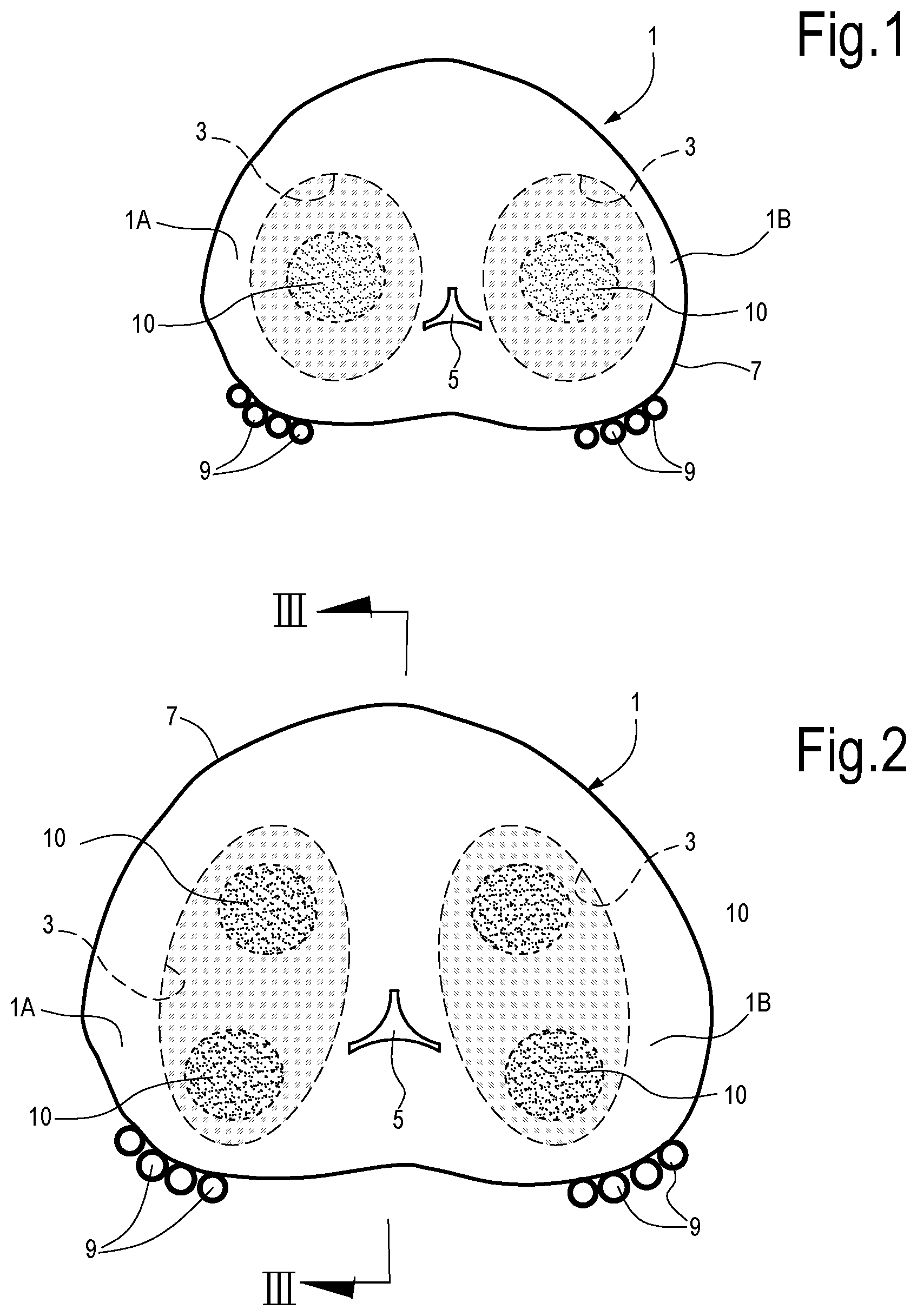 Patent US12324623 Figure 1 – Laser treatment of the prostate