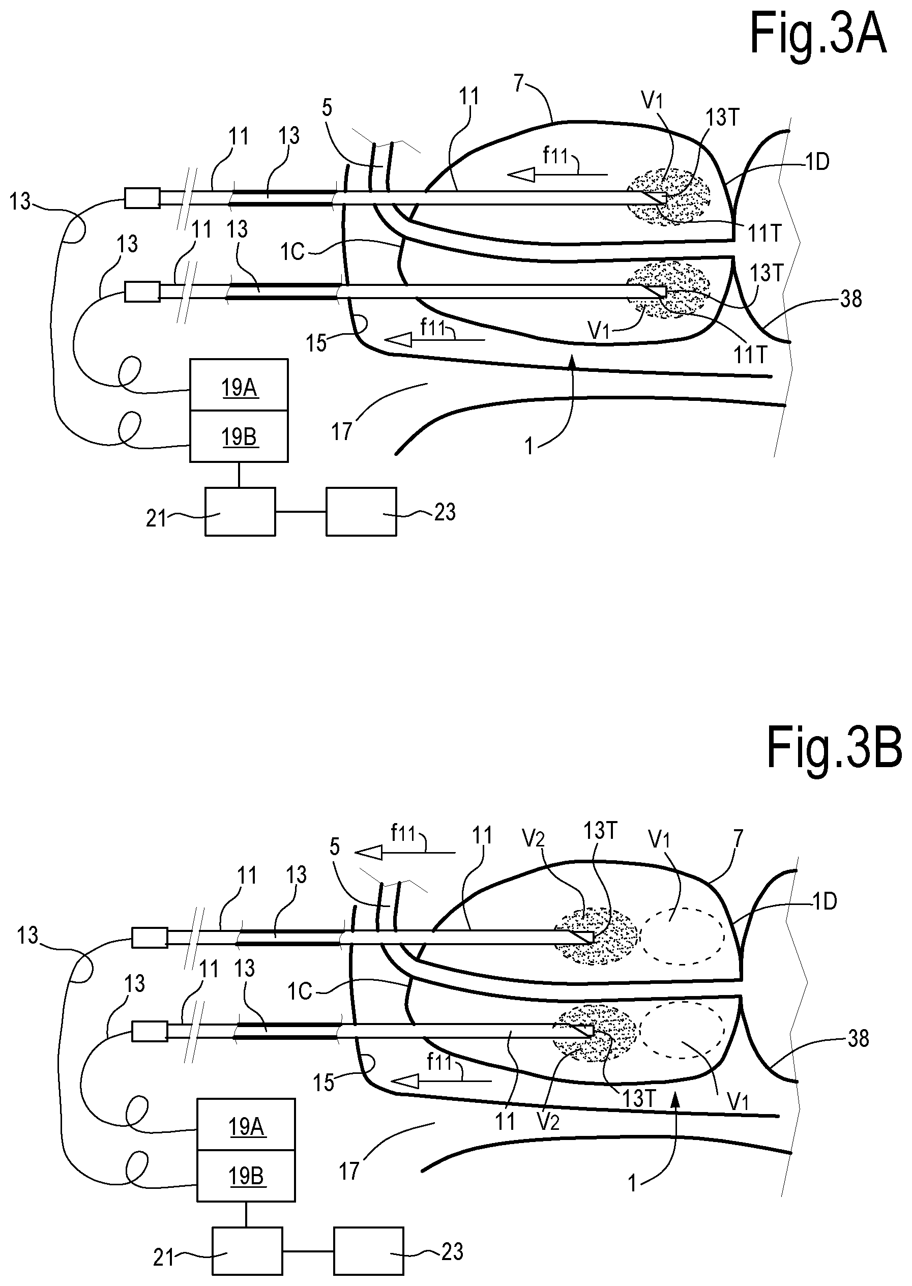 Patent US12324623 Figure 2 – Laser treatment of the prostate