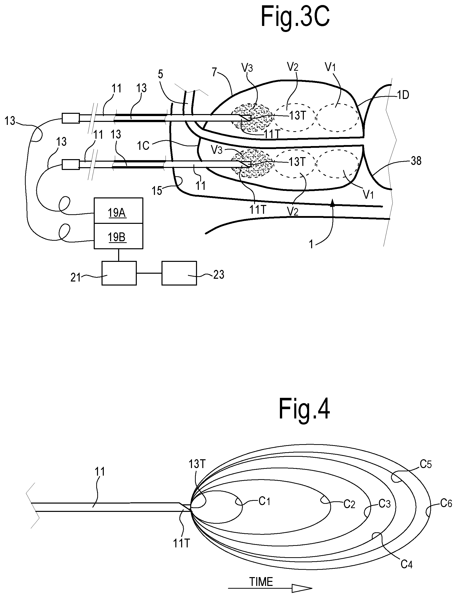 Patent US12324623 Figure 3 – Laser treatment of the prostate