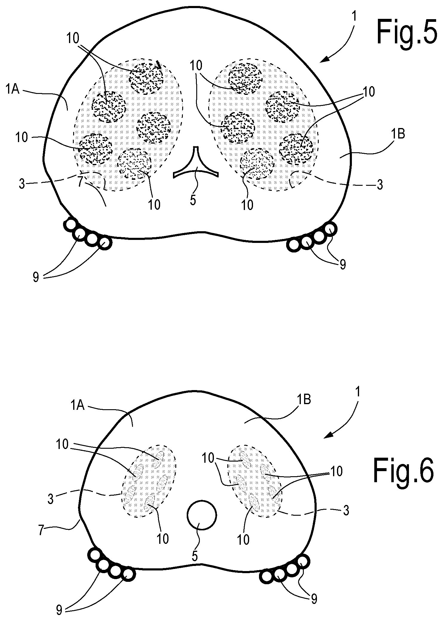 Patent US12324623 Figure 4 – Laser treatment of the prostate