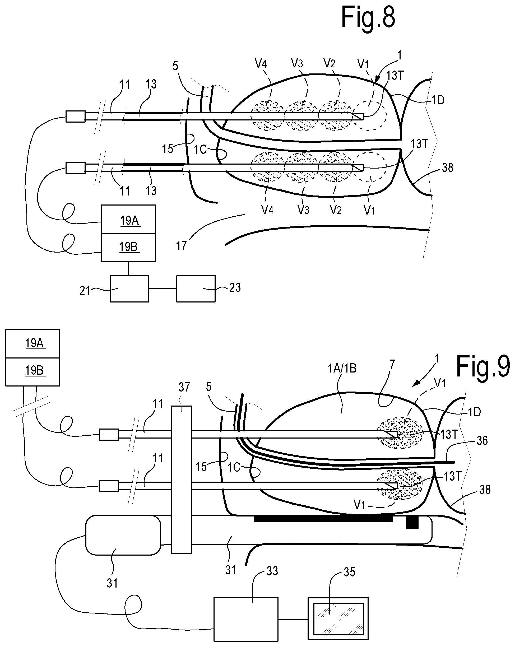 Patent US12324623 Figure 6 – Laser treatment of the prostate