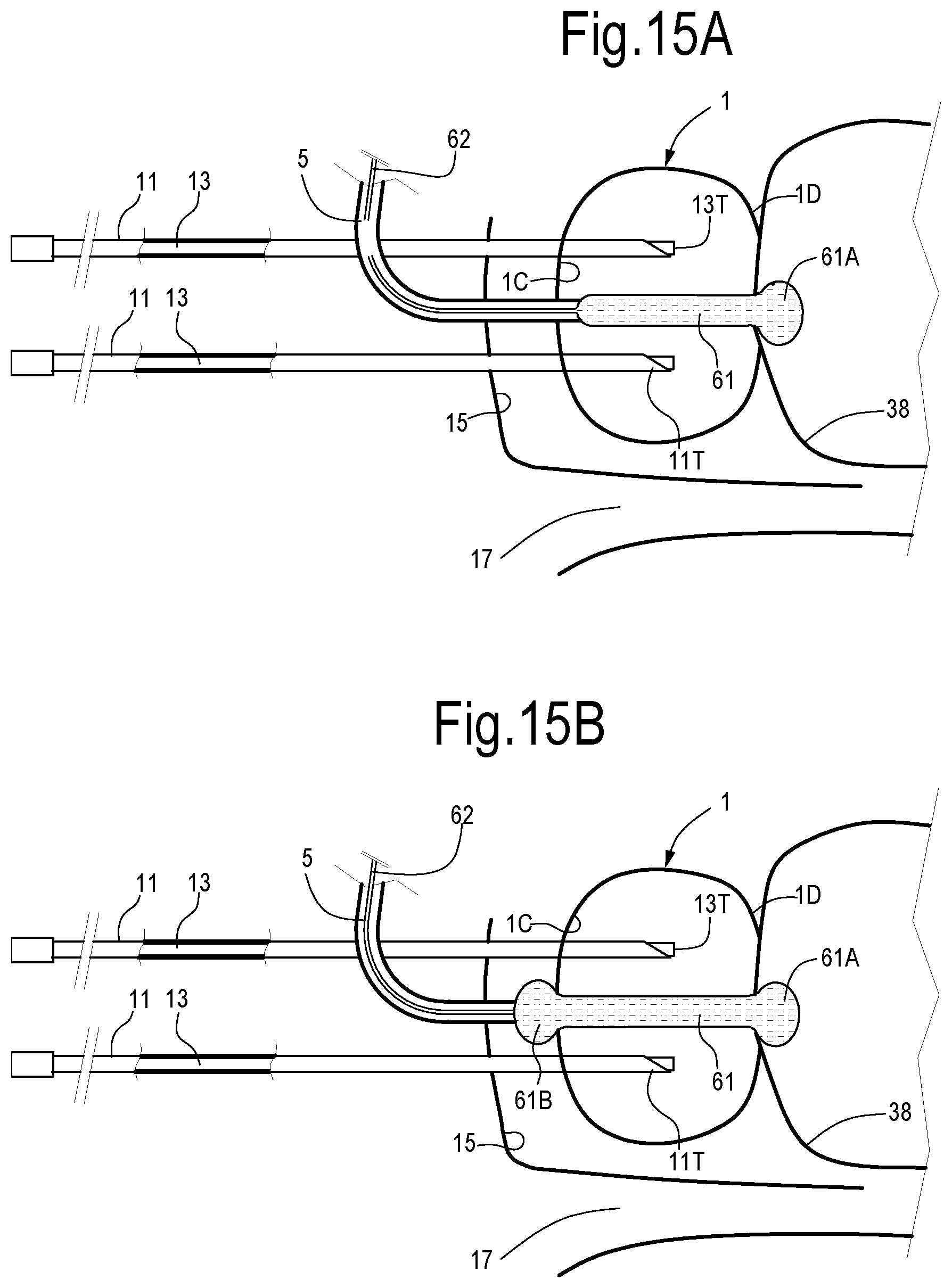 Patent US12324623 Figure 9 – Laser treatment of the prostate