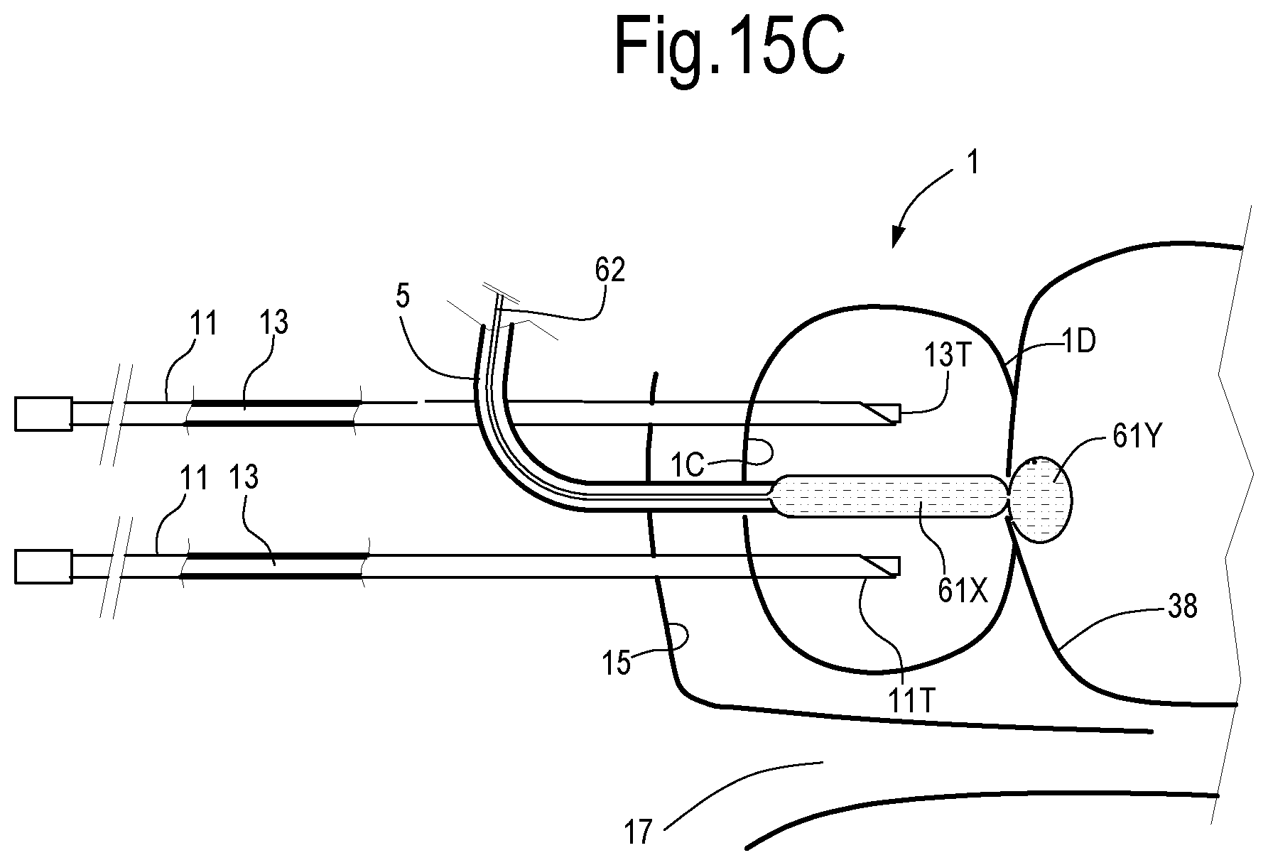 Patent US12324623 Figure 10 – Laser treatment of the prostate