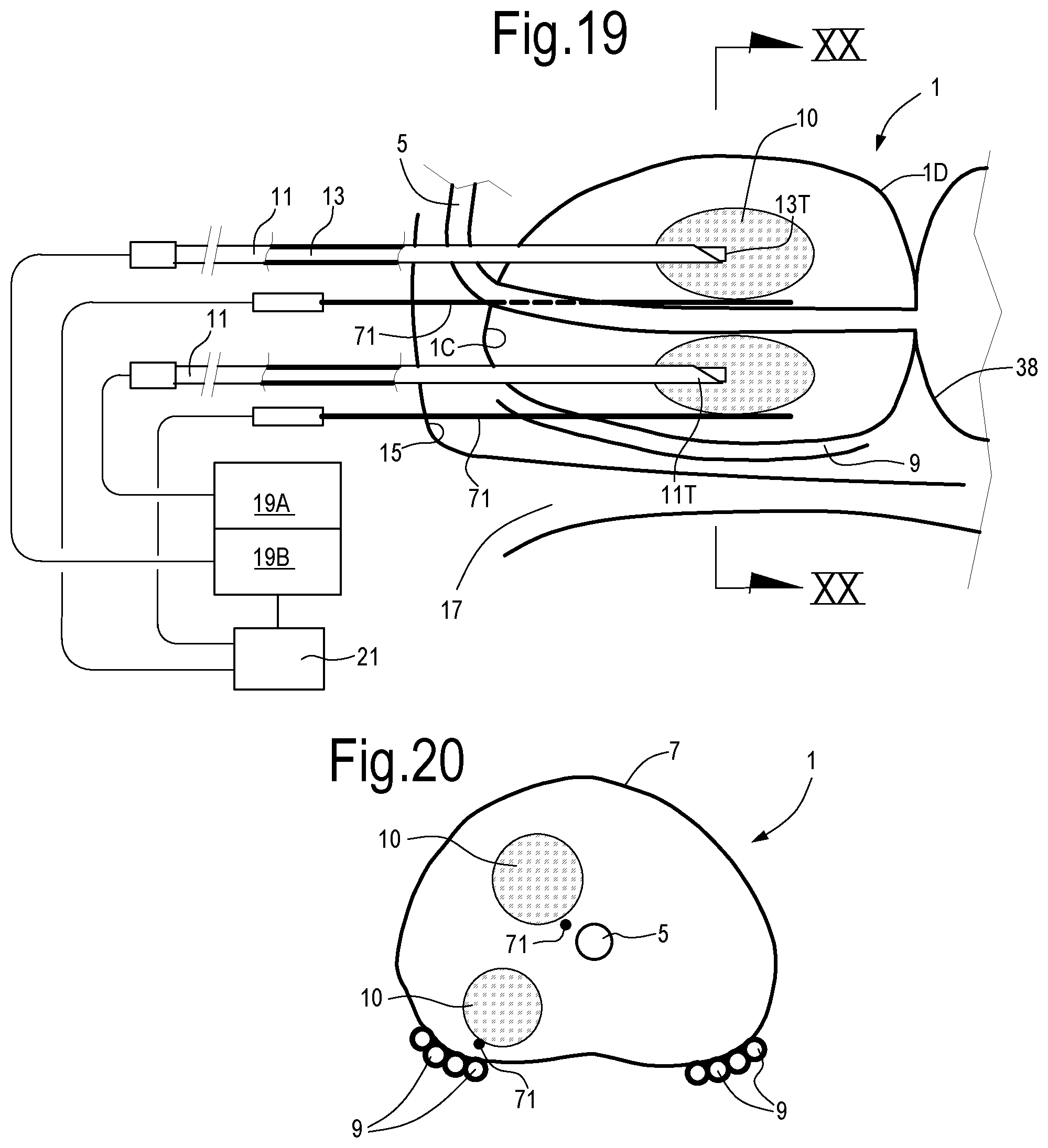 Patent US12324623 Figure 14 – Laser treatment of the prostate