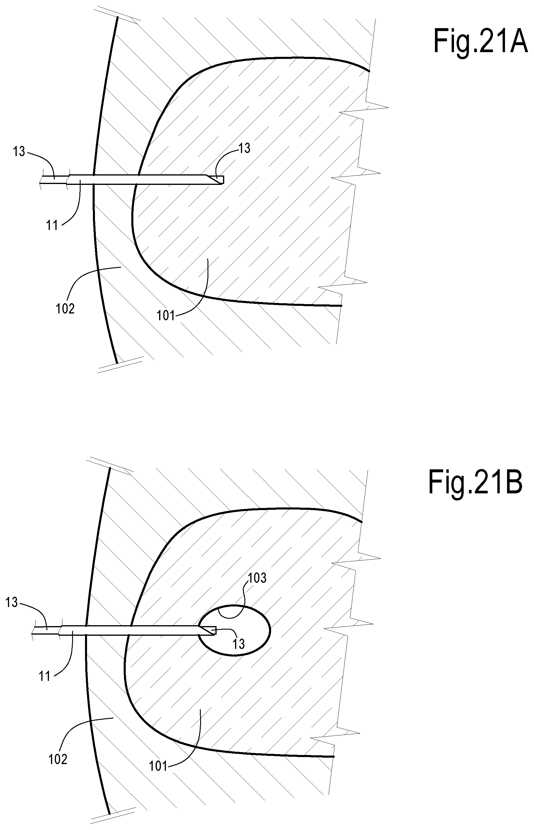 Patent US12324623 Figure 15 – Laser treatment of the prostate