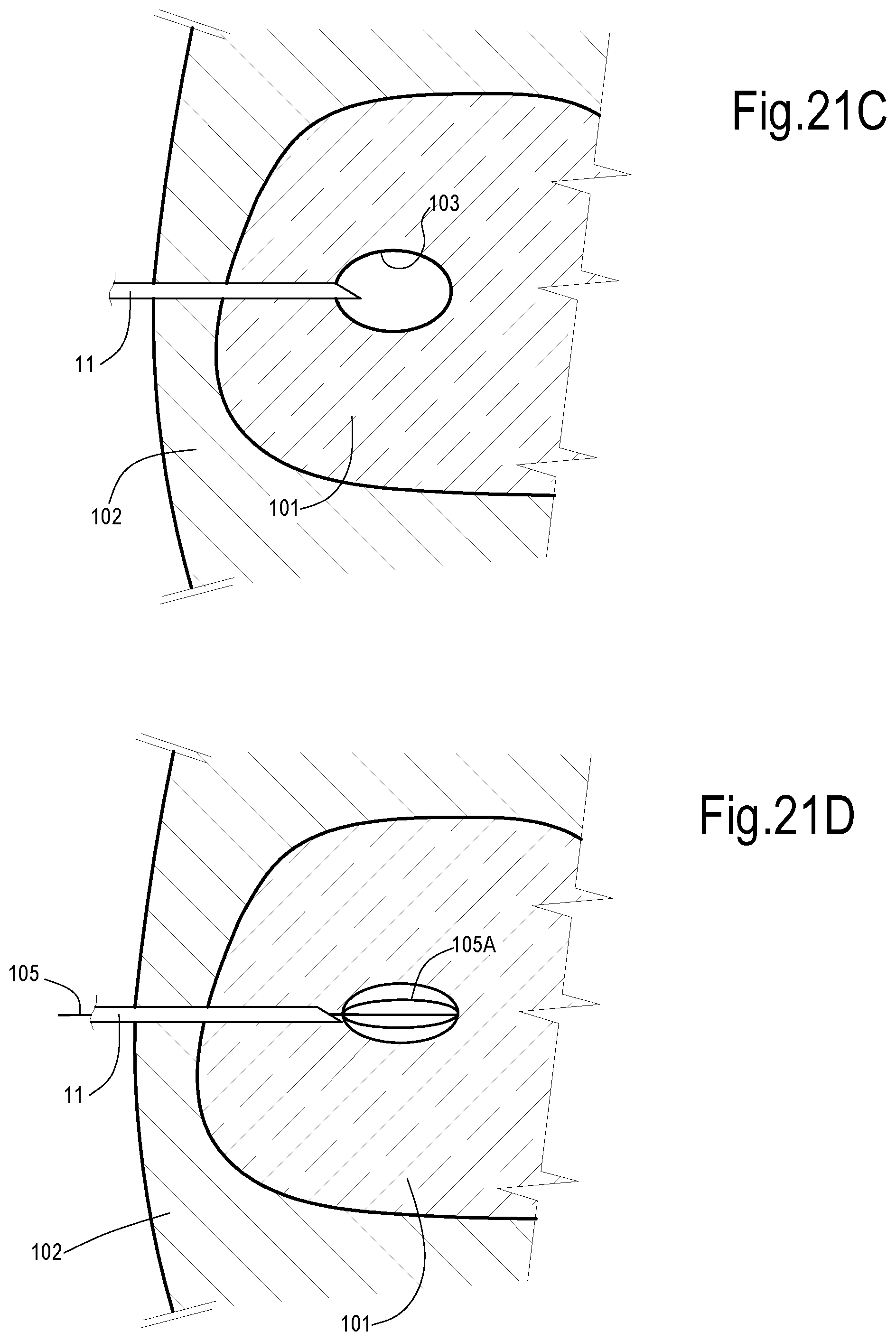 Patent US12324623 Figure 16 – Laser treatment of the prostate