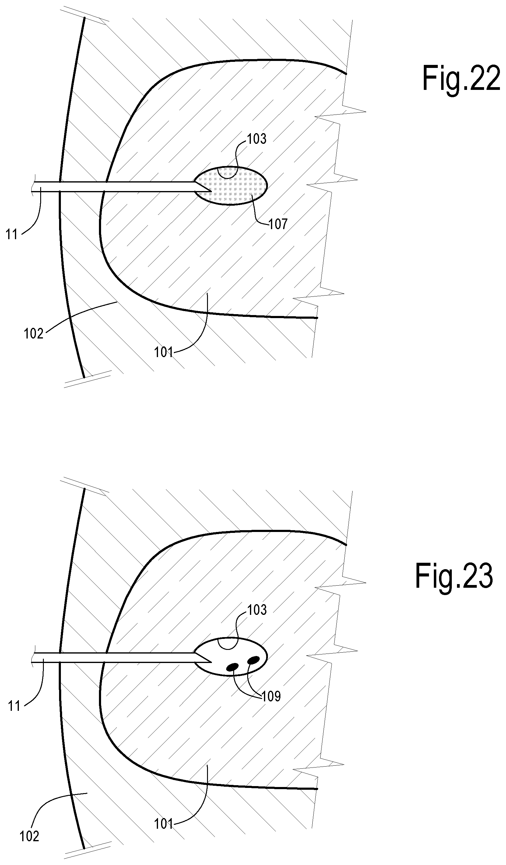 Patent US12324623 Figure 17 – Laser treatment of the prostate