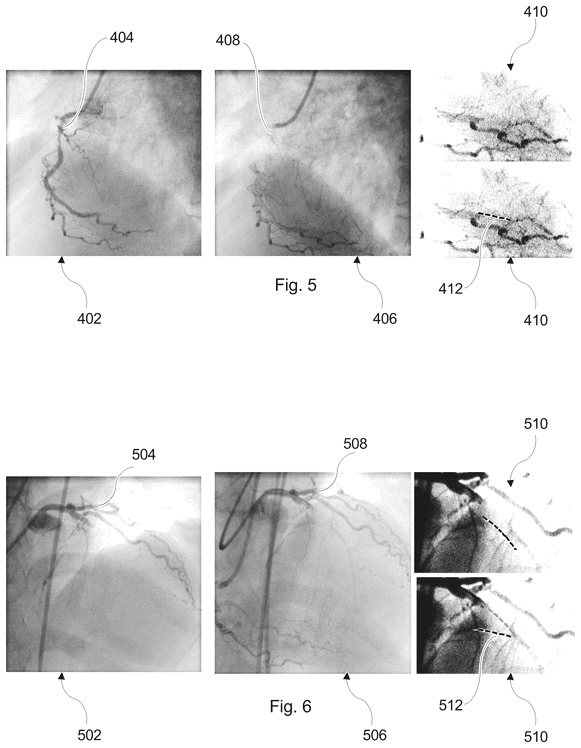 Patent US12324631 Figure 3 – Guidance for treatment of a chronic total occlusion