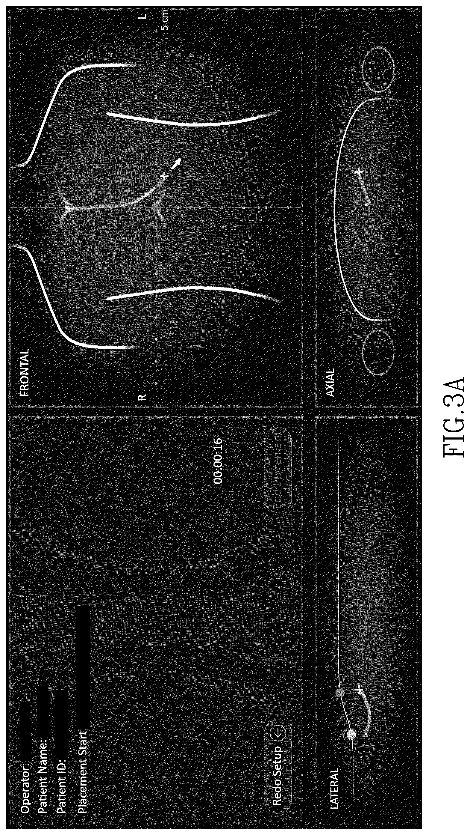 Patent US12324632 Figure 7 – Insertion device positioning guidance system and method