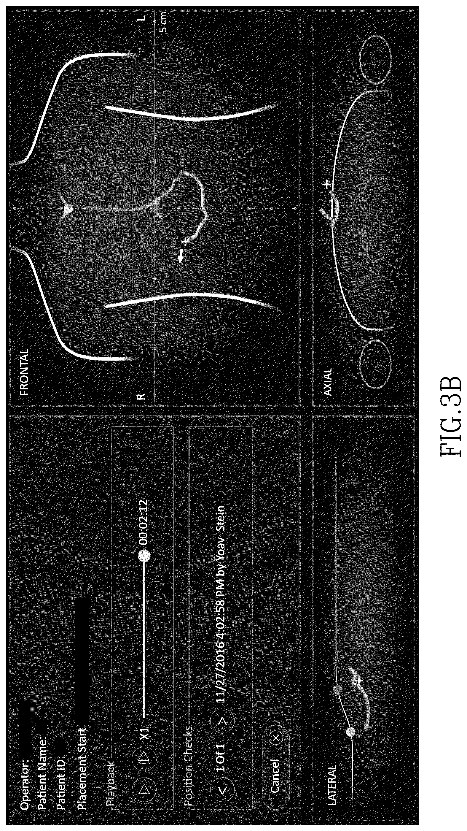 Patent US12324632 Figure 8 – Insertion device positioning guidance system and method