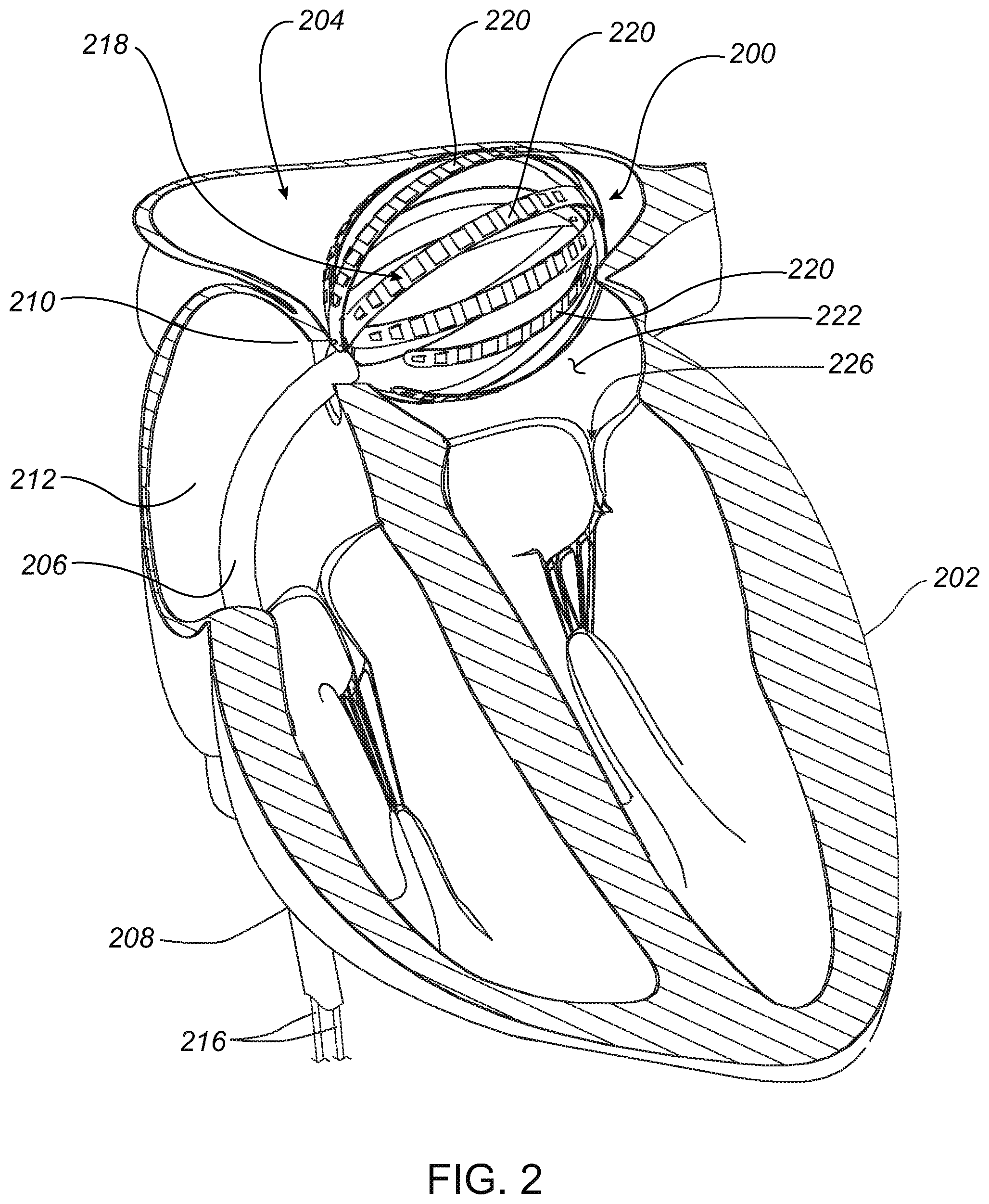 Patent US12324636 Figure 2 – Systems and methods for selecting, activating, or selecting and activating transducers